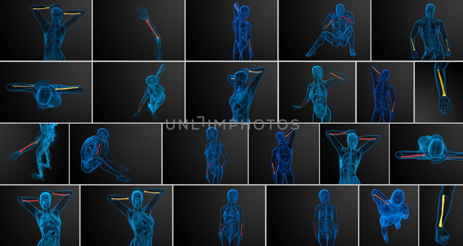3d rendering medical illustration of the radius bone 