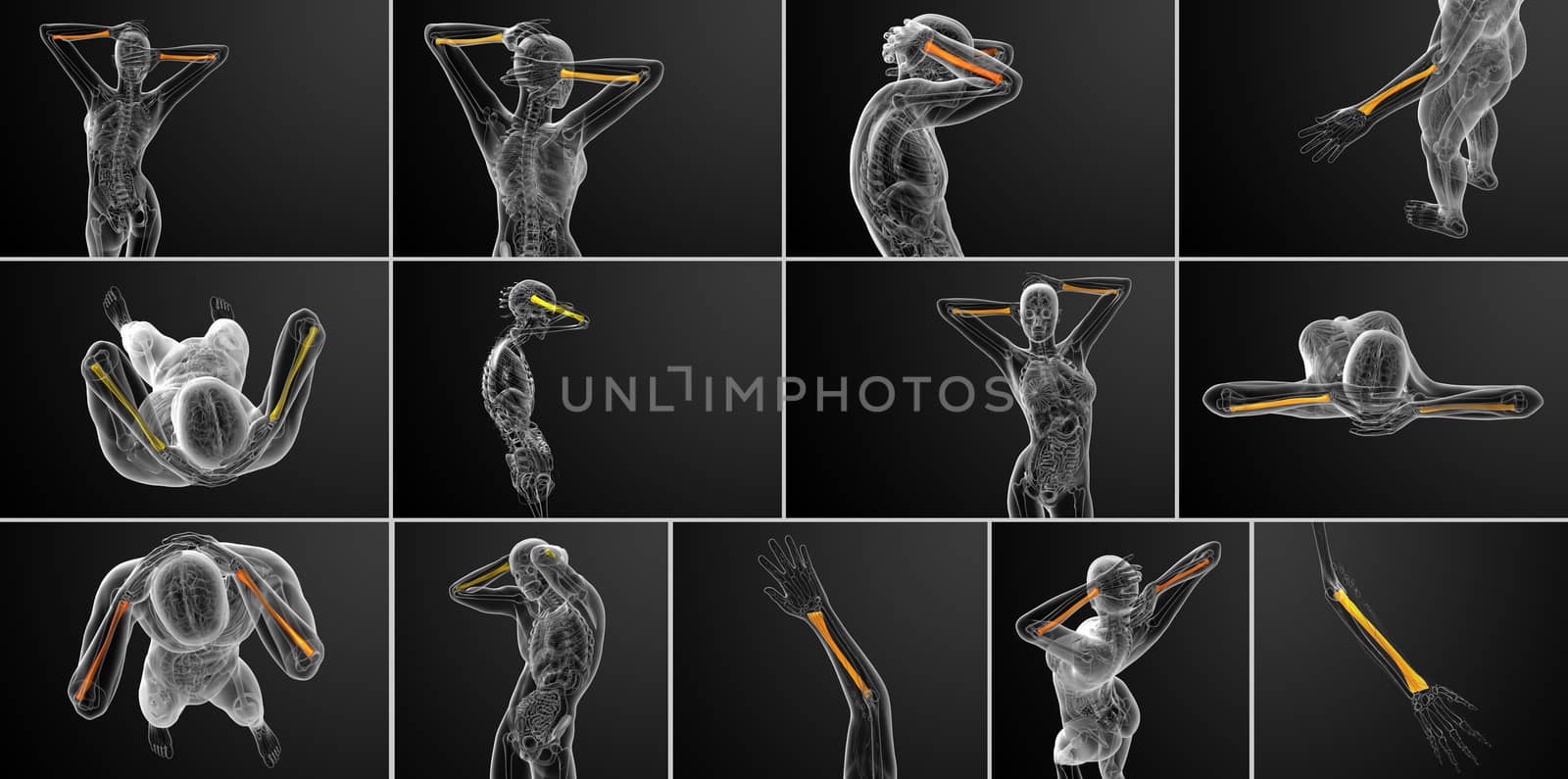 3d rendering medical illustration of the radius bone