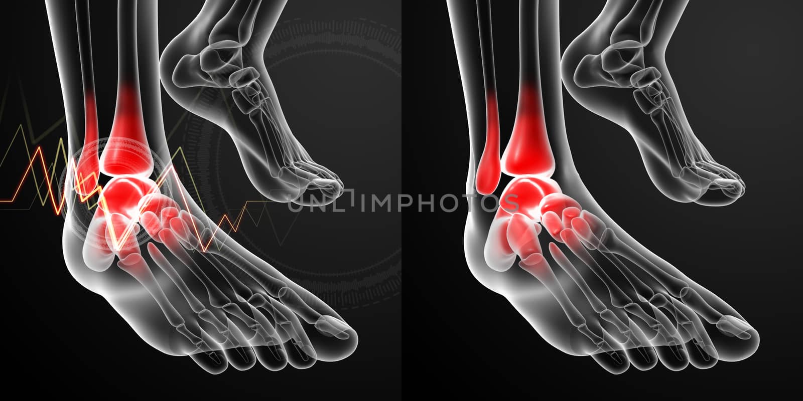 3D rendering illustration of the Ankle pain