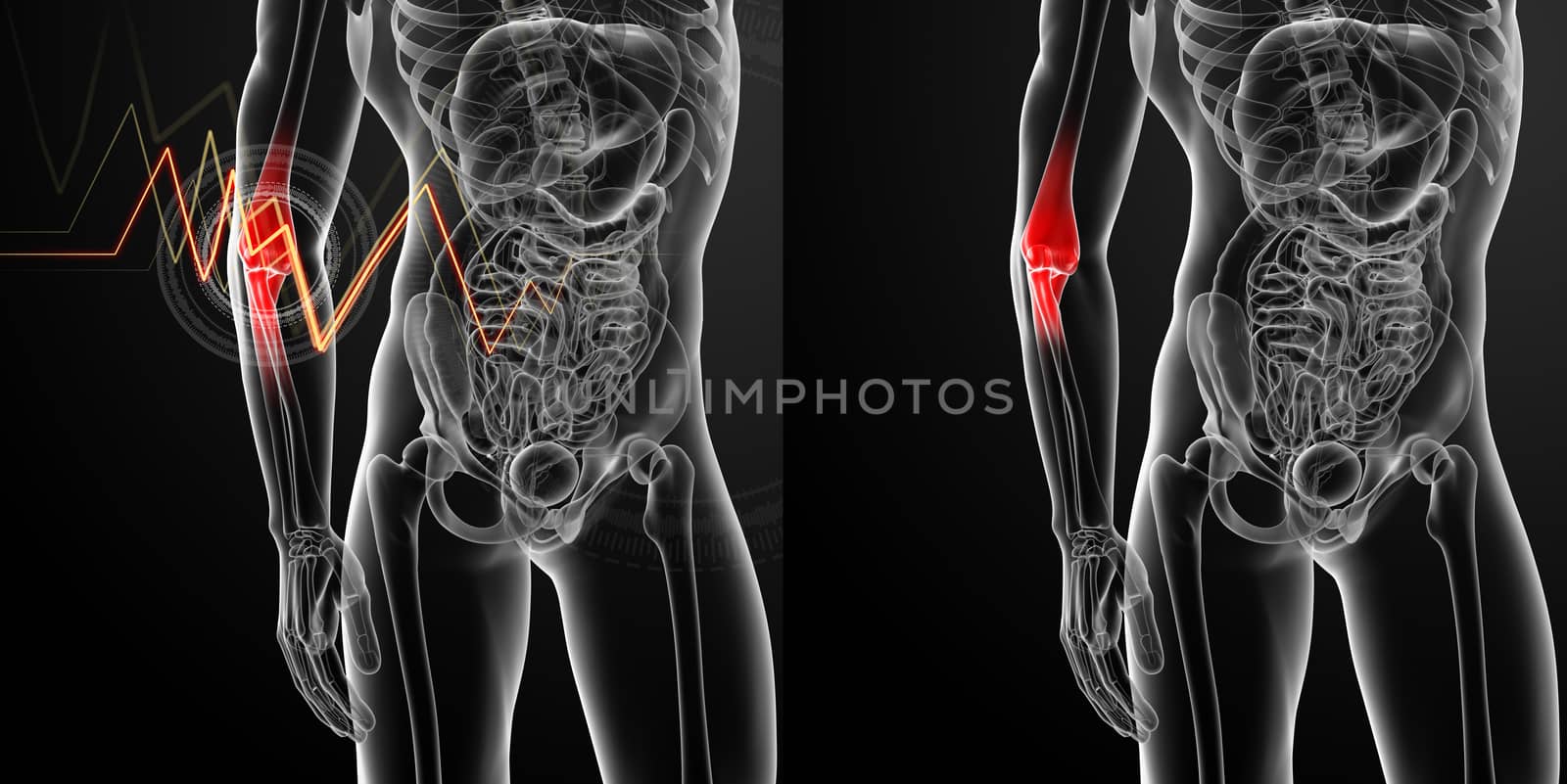 3d render medical illustration of the arm pain