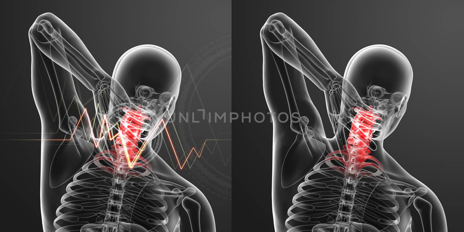 3d rendered illustration - pain neck