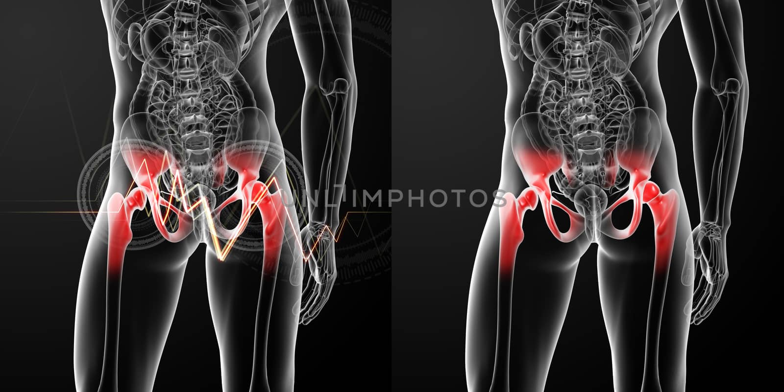3D rendering medical illustration of a painful hip joint 