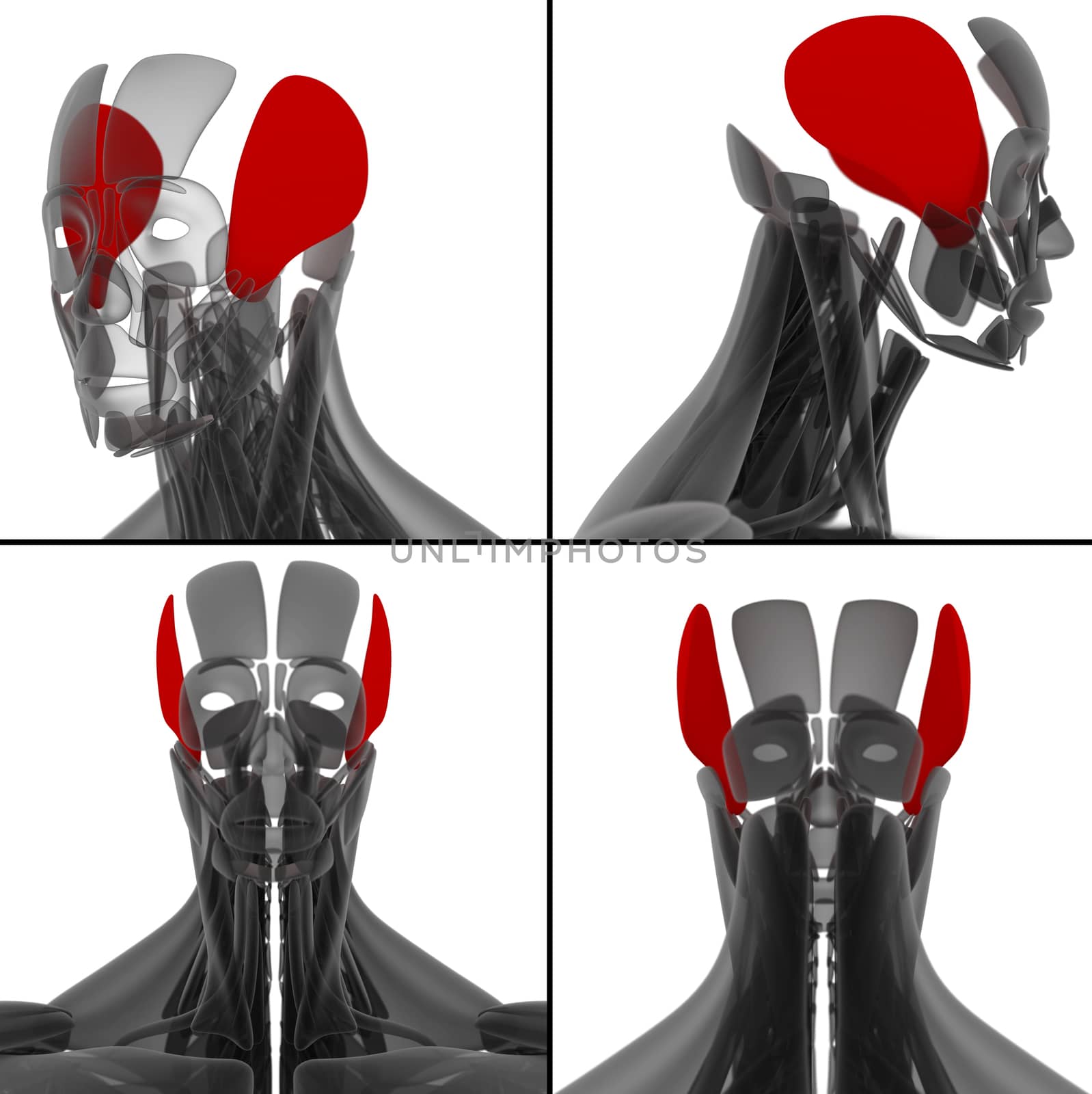 medical illustration of the temporalis