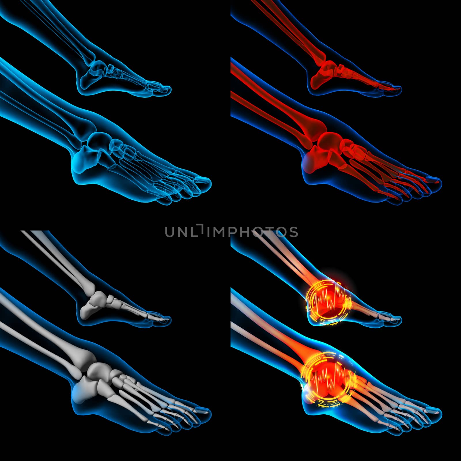 3D rendering human foot pain with the anatomy of a skeleton foot