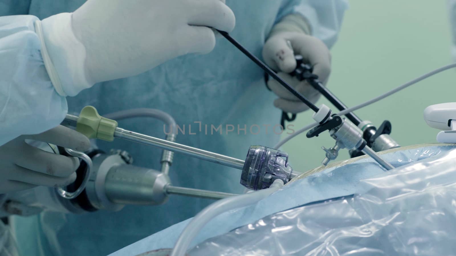 Laparoscopic surgery of the abdomen. The team of medical specialists conducting laparoscopic surgery.