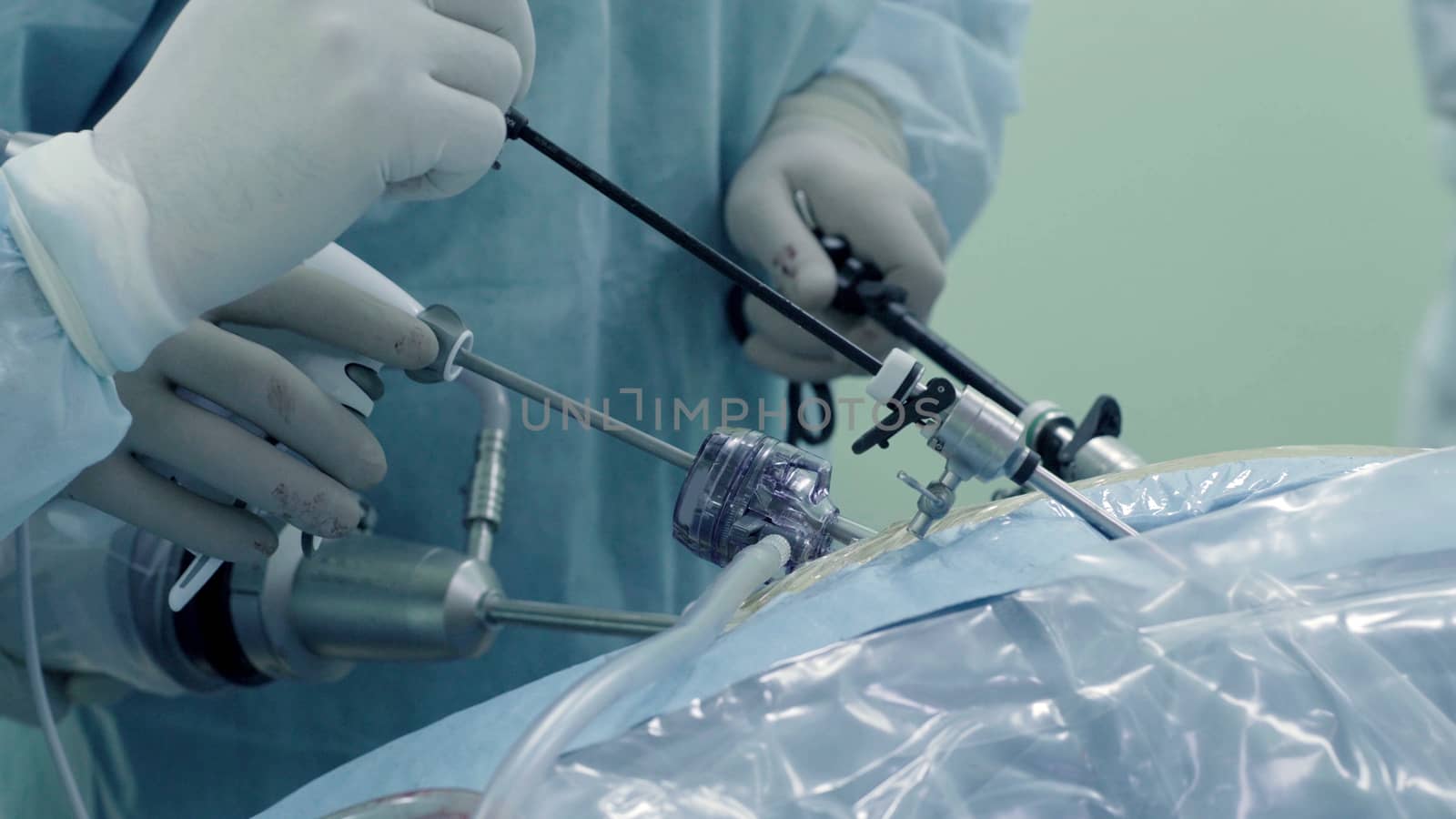 Laparoscopic surgery of the abdomen. The team of medical specialists conducting laparoscopic surgery.