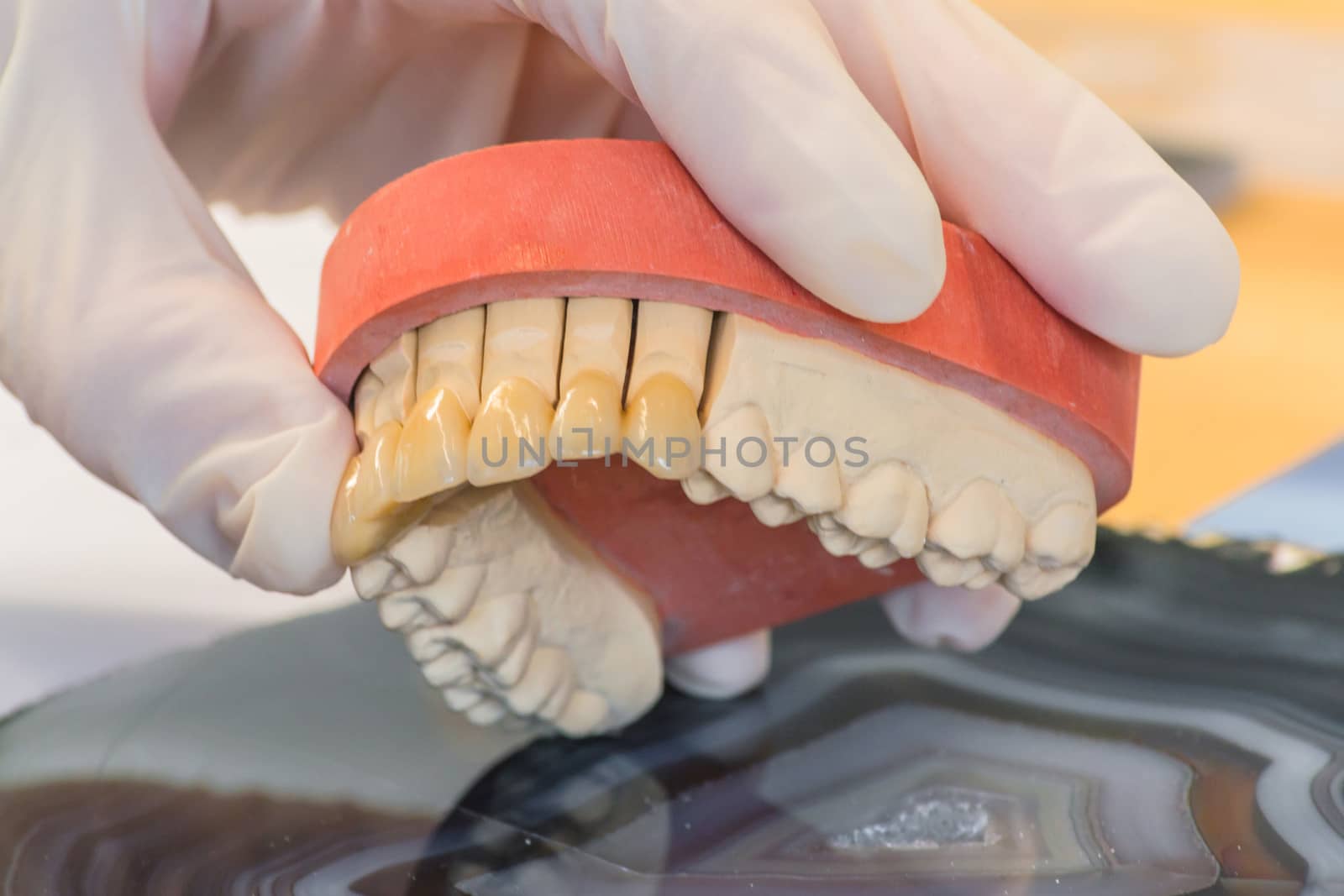 Dentures, prosthesis by JFsPic