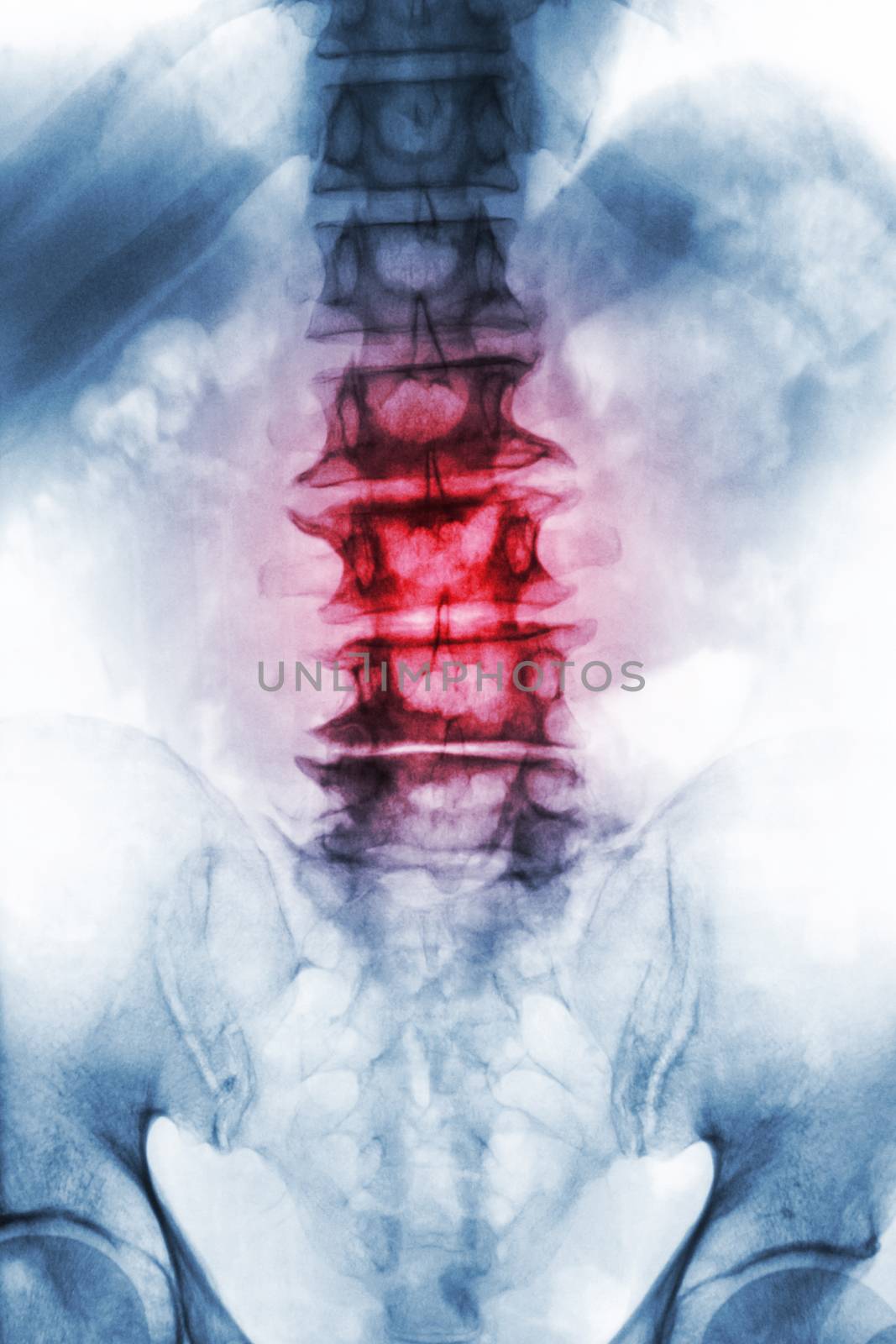 Spondylosis . film x-ray lumbosacral spine of old aged patient show osteophyte , collapse spine from degenerative process . Front view by stockdevil