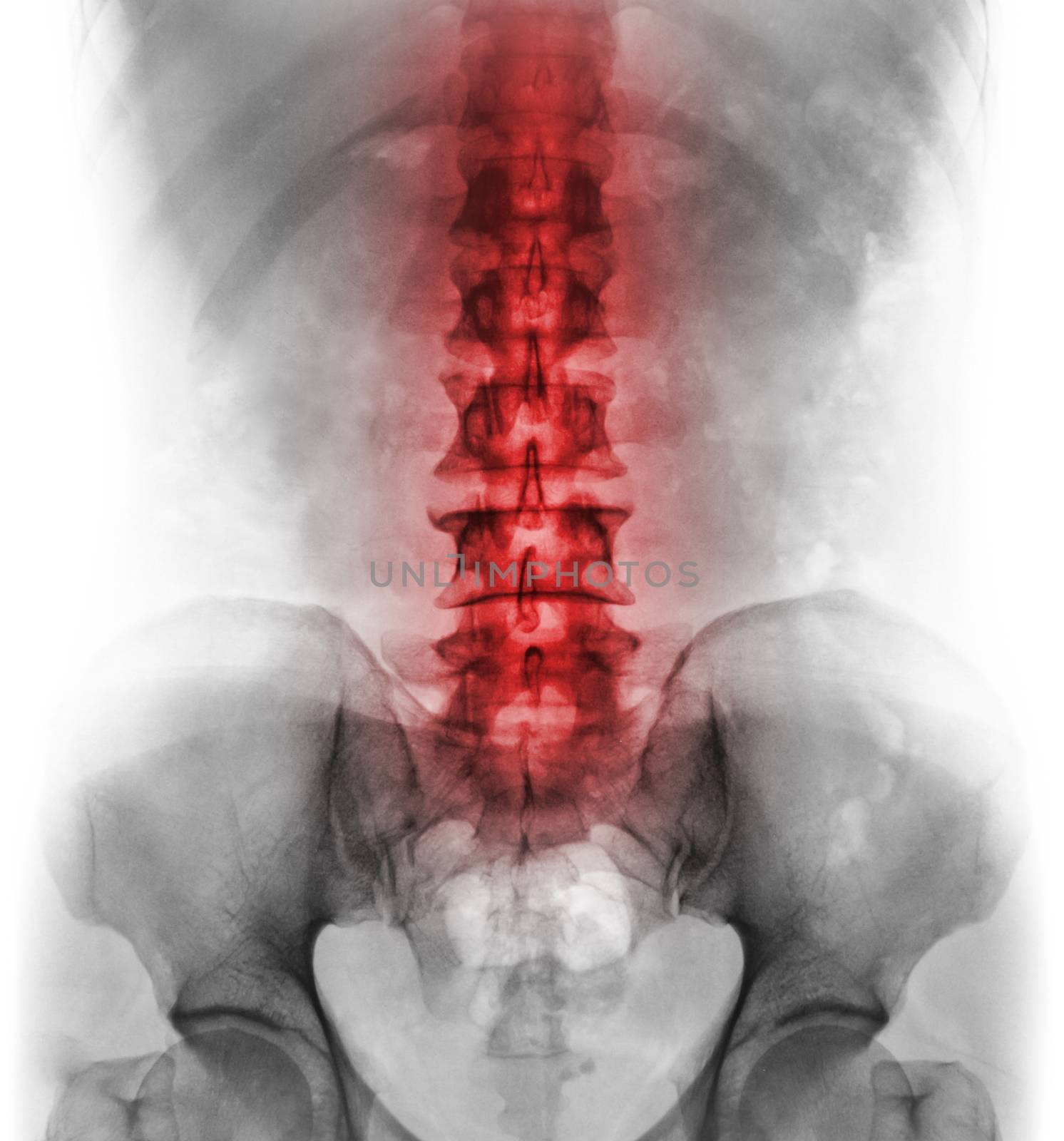 Inflammation of lumbosacral spine . Concept of vertebral care .