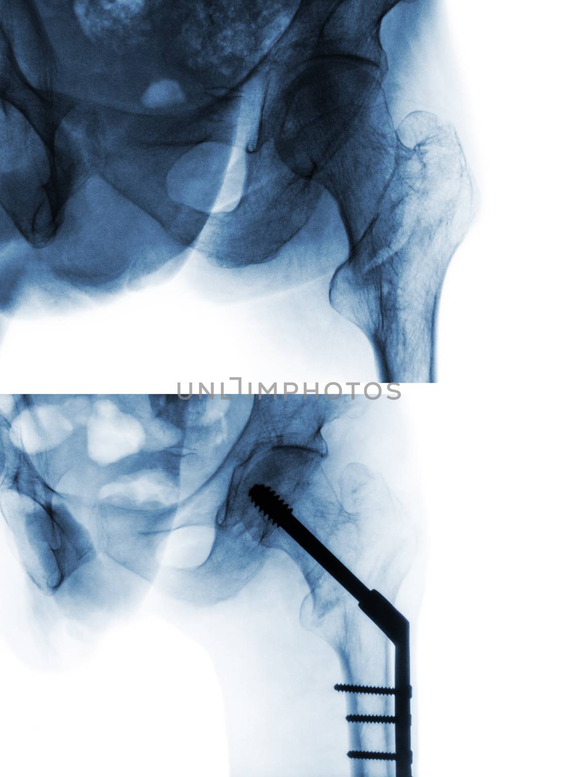 Intertrochanteric fracture femur ( thigh bone ). X-ray of hip and comparison between before surgery (upper image) and after surgery (lower image). Patient was operated and insert intramedullary nail by stockdevil