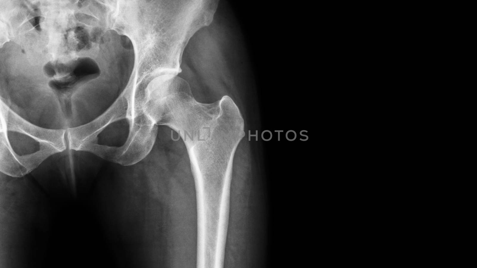X-ray normal pelvis and hip joint . Blank area at right side .