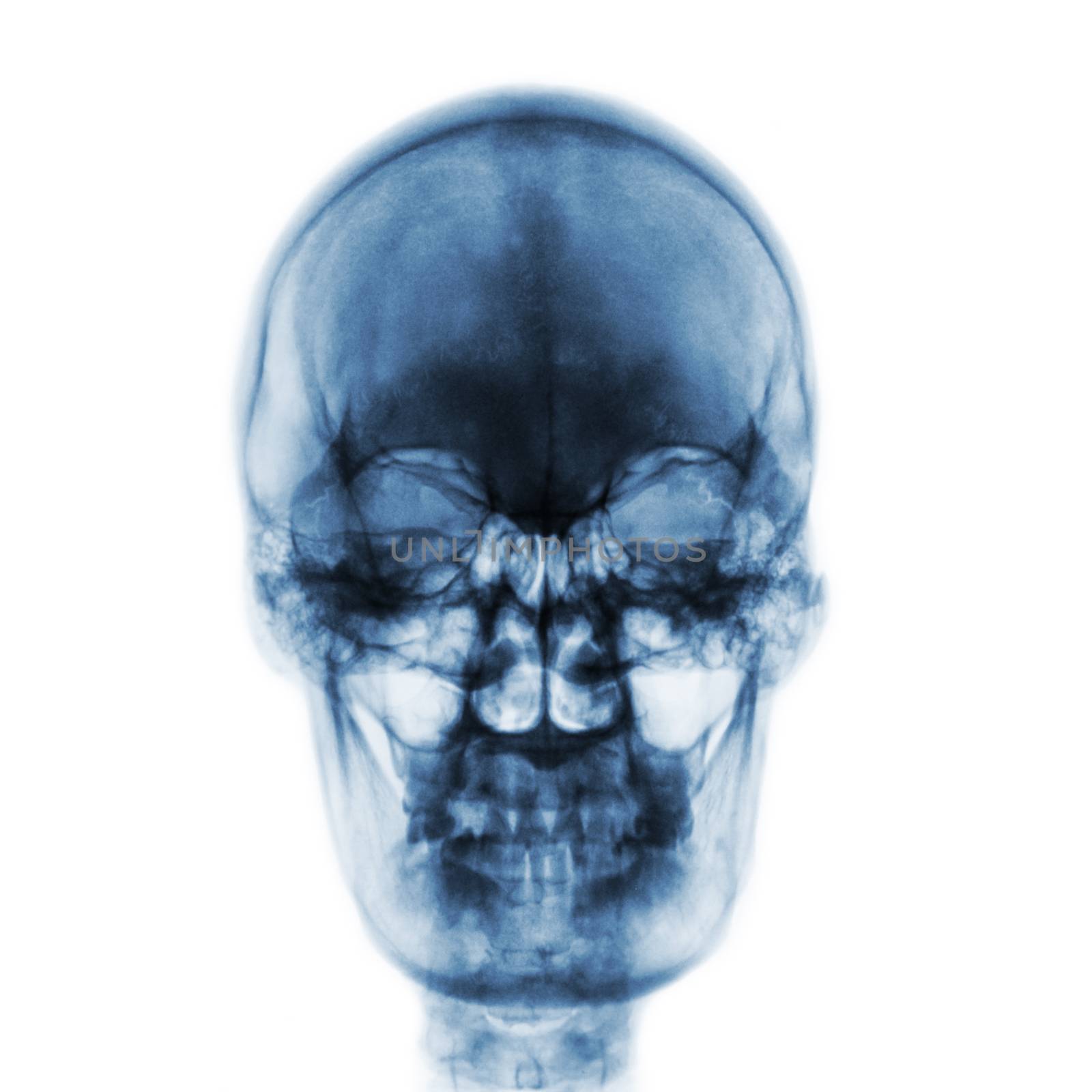 Film x-ray of normal human skull on isolated background . Front view by stockdevil