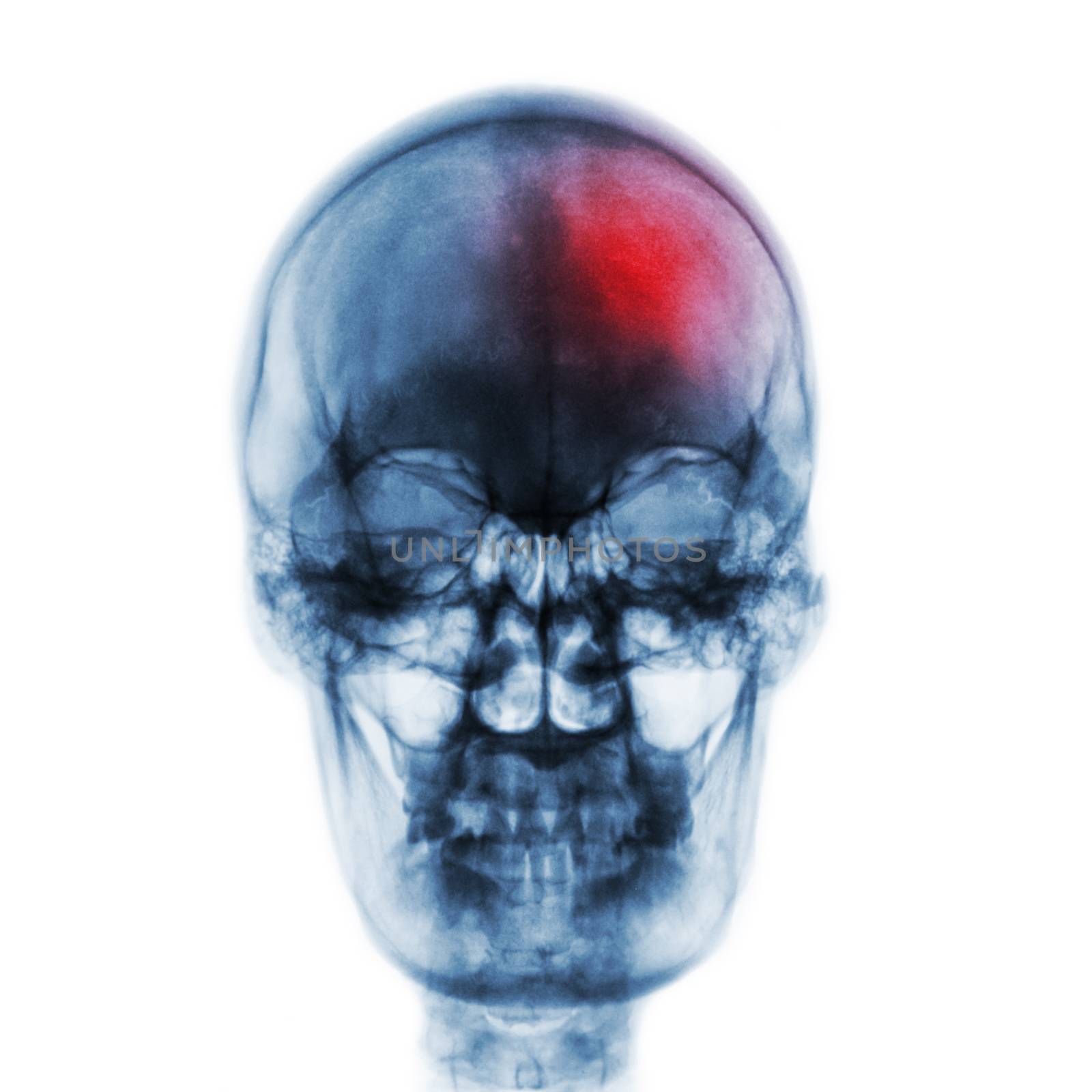 Stroke ( Cerebrovascular accident ) . Film x-ray skull of human with red area . Front view .