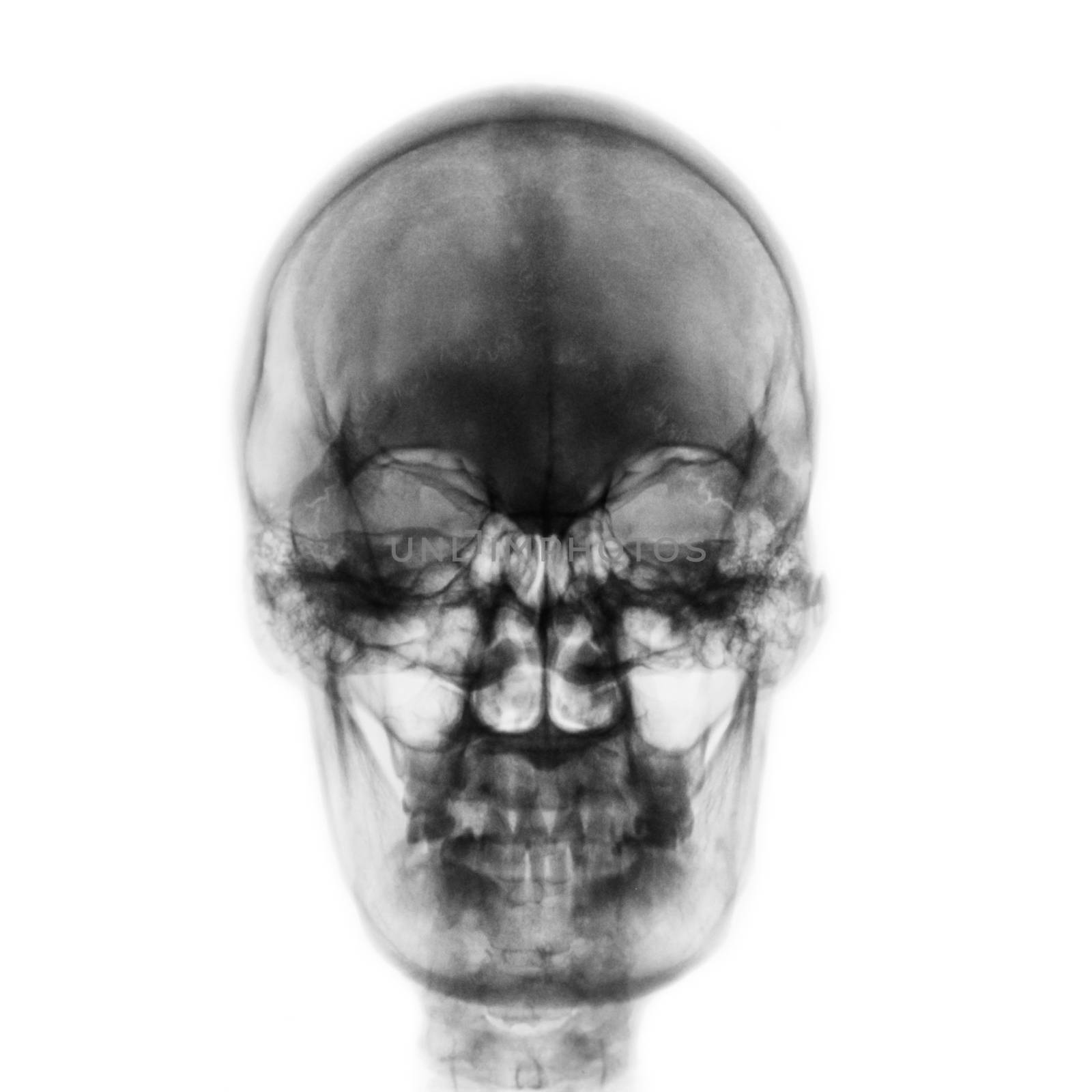 Film x-ray of normal human skull on isolated background . Front view by stockdevil