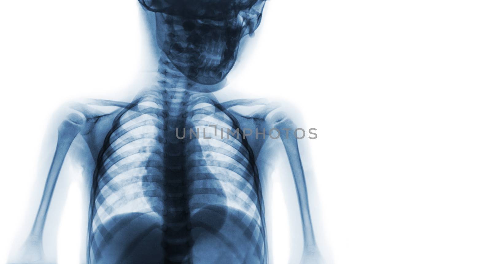 Film x-ray upper half body of child and blank area at right side by stockdevil