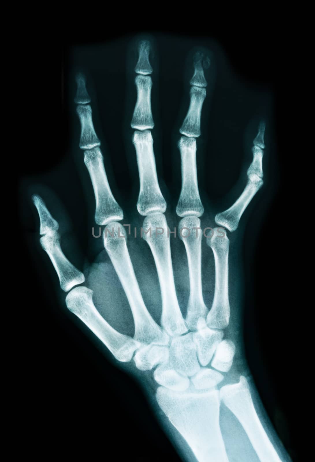 X-ray of a hand by Gamjai
