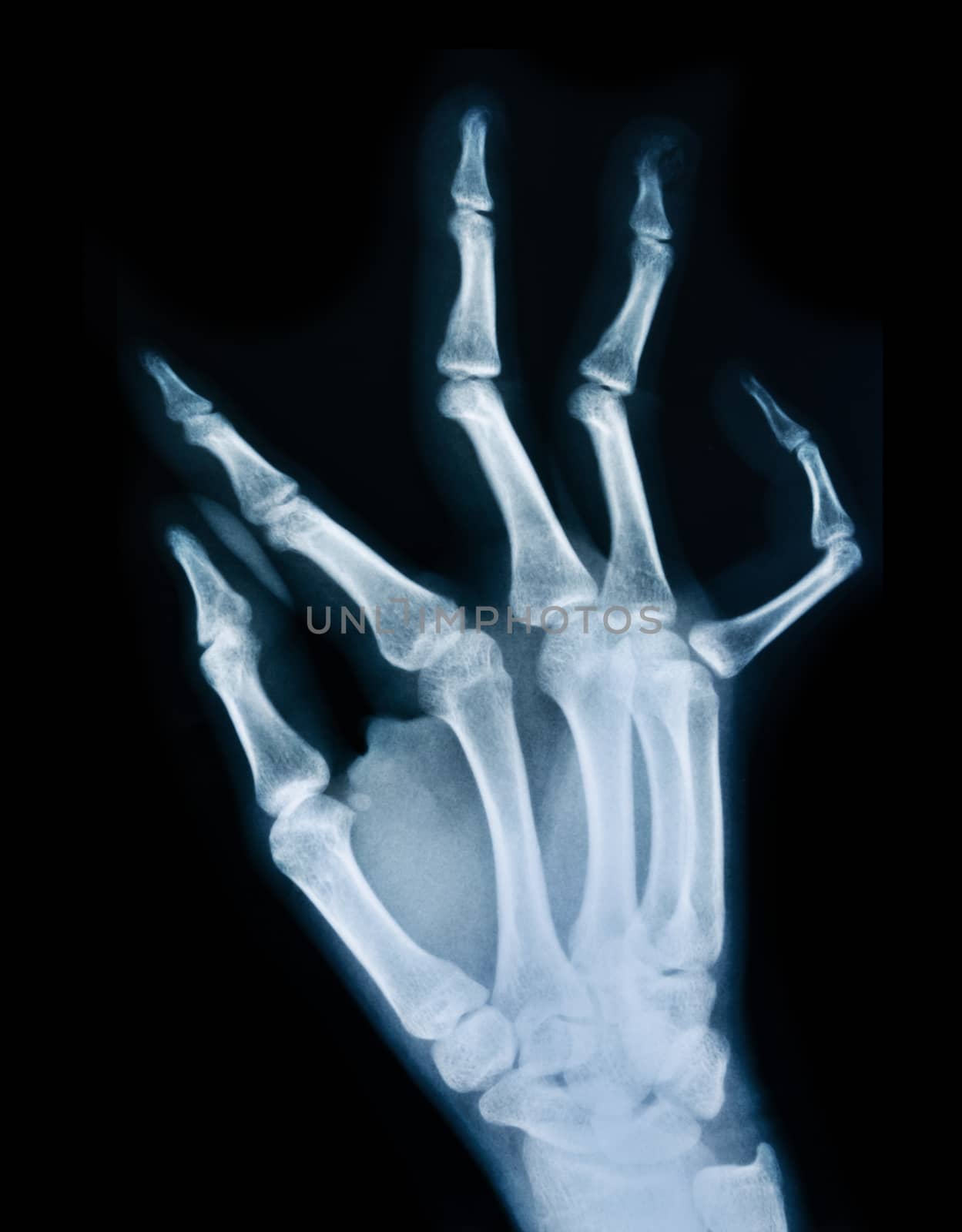 X ray of a hand. by Gamjai