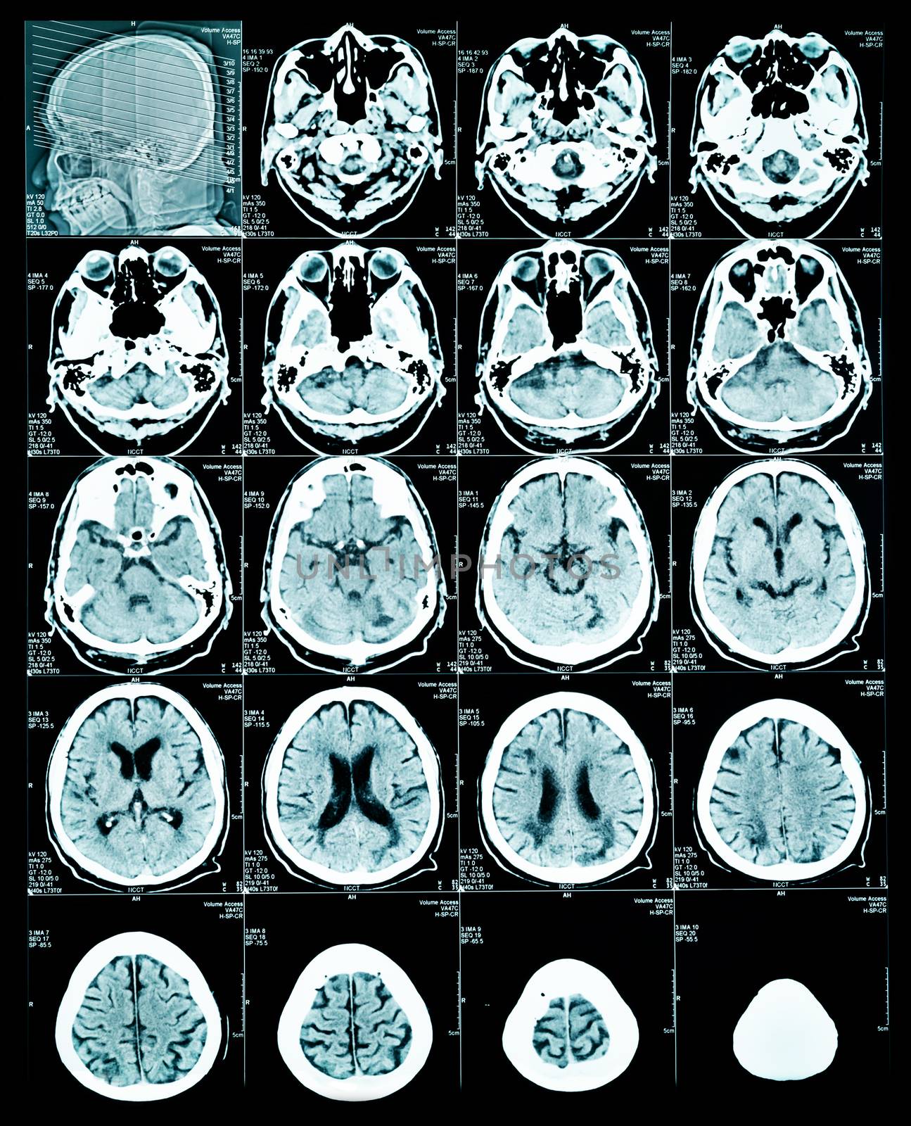 MRI scan image of brain. by Gamjai