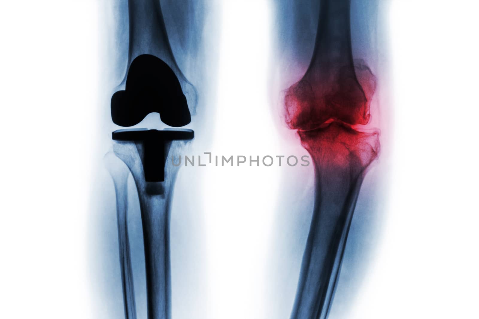 Film x-ray of osteoarthritis knee patient and artificial joint ( Total knee replacement ) . Isolated background .