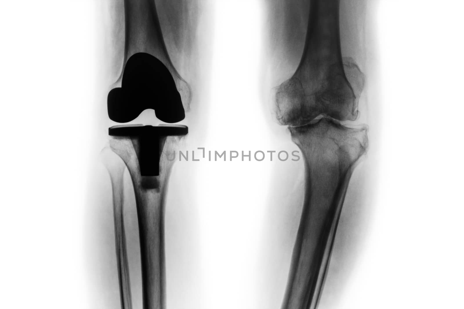 Film x-ray of osteoarthritis knee patient and artificial joint ( Total knee replacement ) . Isolated background . by stockdevil