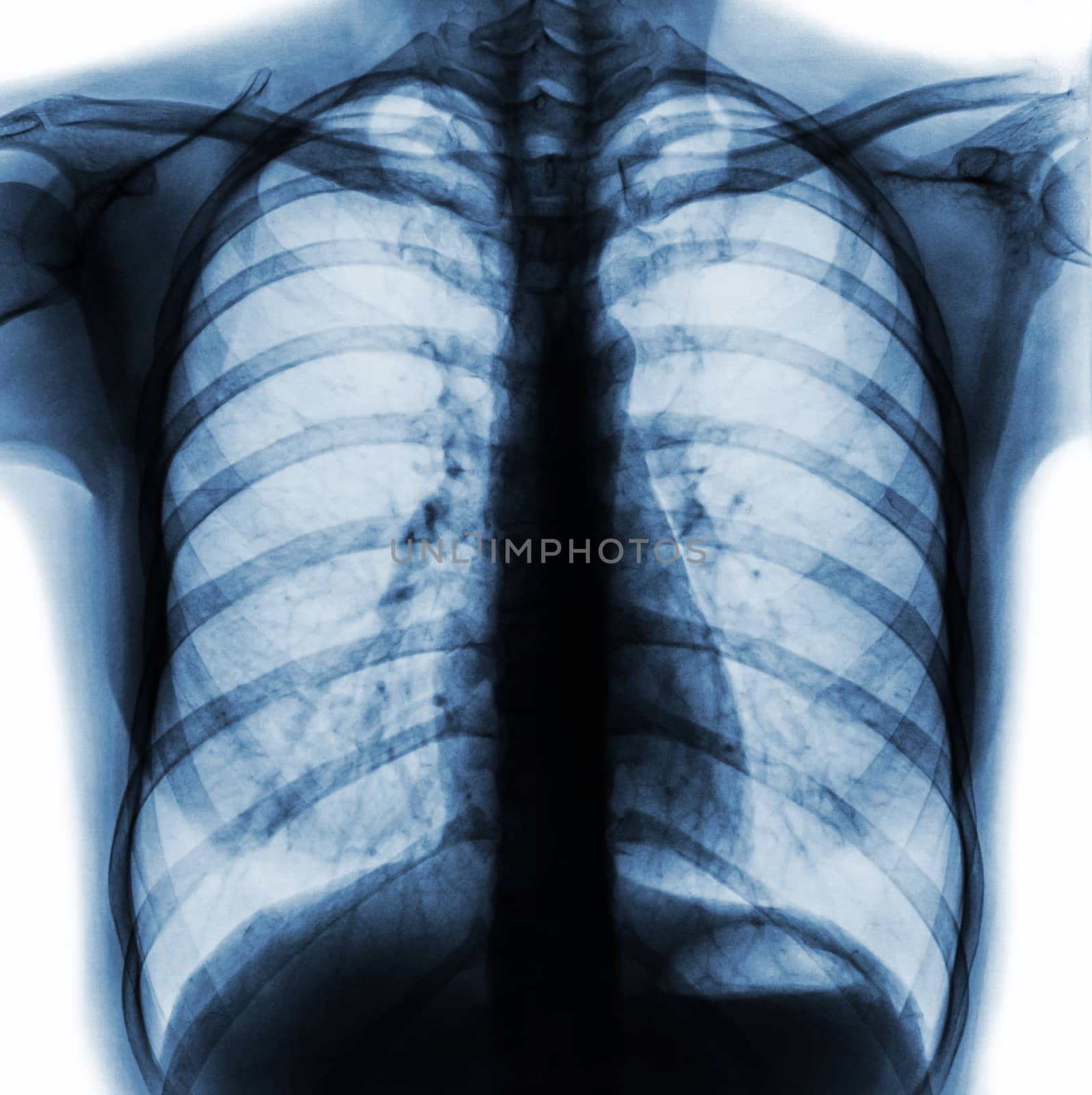 Film chest x-ray PA upright show normal human chest . by stockdevil