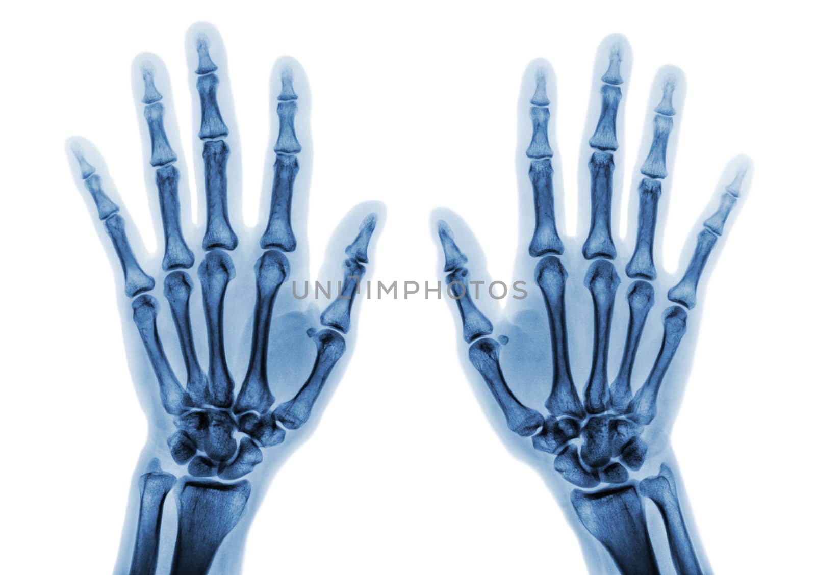 Film x-ray both hand AP show normal human hands on white background ( isolated ) by stockdevil