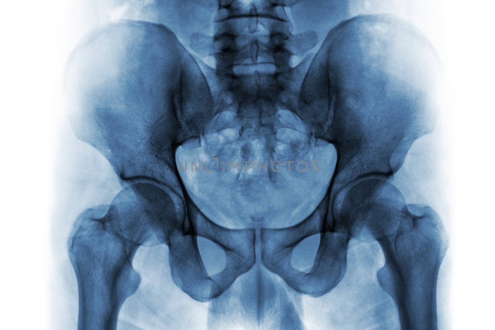 Film x-ray of normal human pelvis and hip joints . by stockdevil