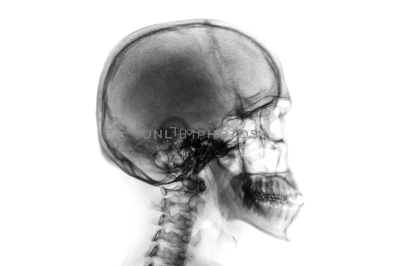 X-ray normal skull and cervical spine . Lateral view . Invert color style . by stockdevil