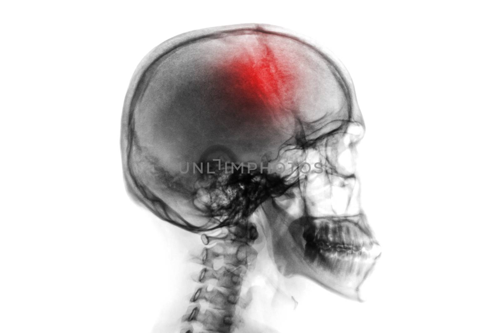 Stroke . Cerebrovascular accident . Film x-ray of human skull and cervical spine . by stockdevil