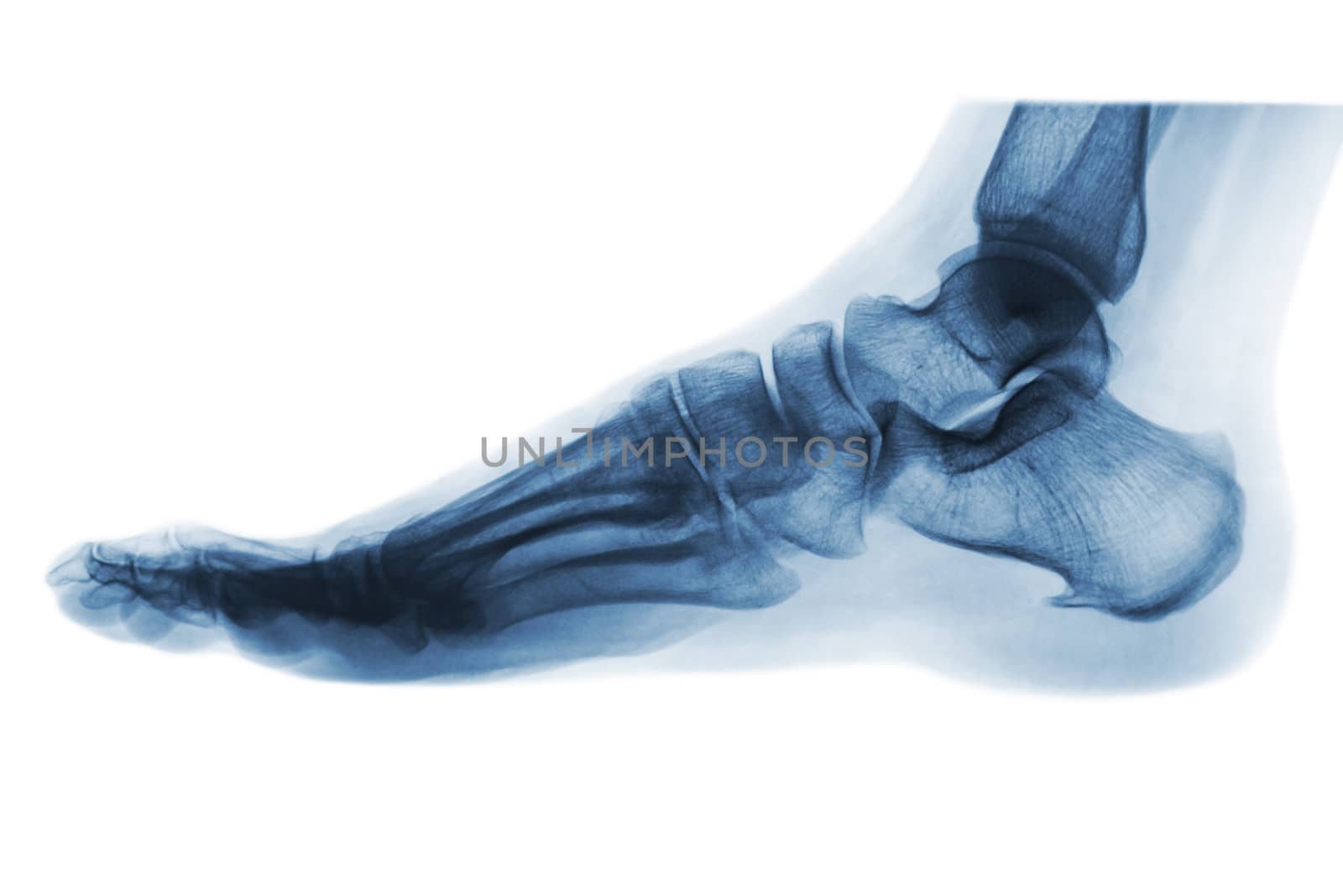 X-ray normal human foot . Lateral view . Invert color style . by stockdevil