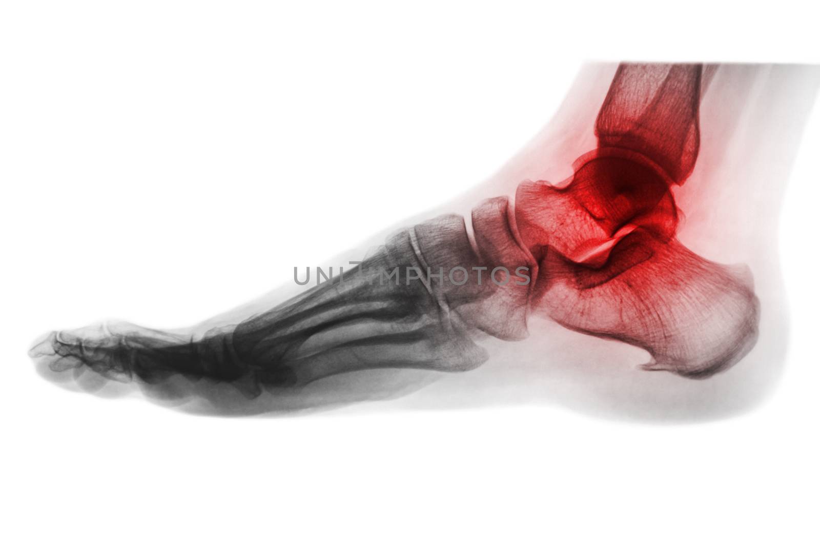 Arthritis of ankle . X-ray of foot . Lateral view . Invert color style . by stockdevil