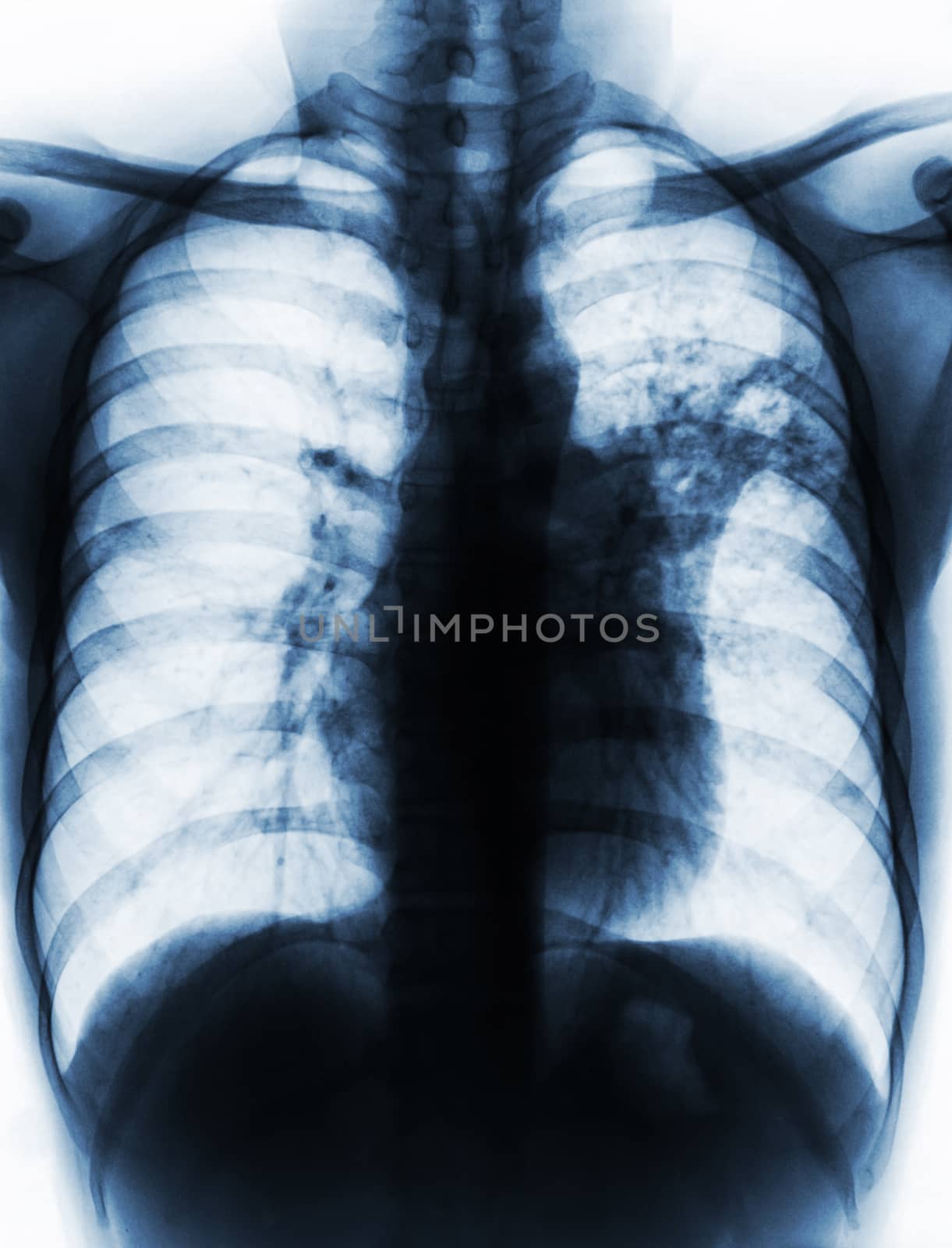 Pulmonary Tuberculosis . Film chest x-ray show alveolar infiltrate at left middle lung due to Mycobacterium tuberculosis infection . by stockdevil