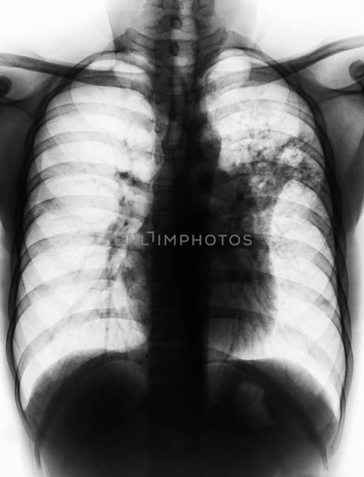 Pulmonary Tuberculosis . Film chest x-ray show alveolar infiltrate at left middle lung due to Mycobacterium tuberculosis infection .