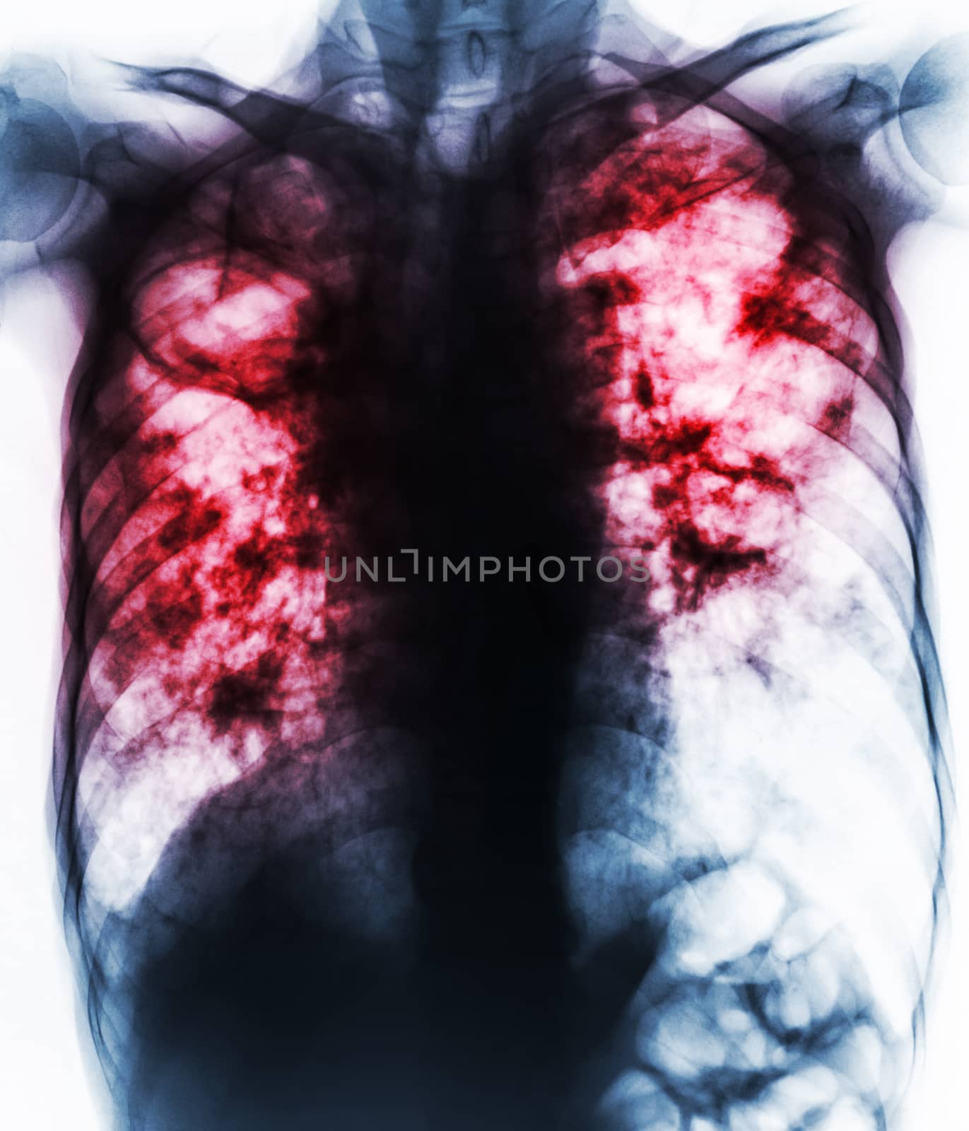 Pulmonary Tuberculosis . Film chest x-ray show fibrosis,cavity,interstitial infiltration both lung due to Mycobacterium tuberculosis infection . by stockdevil