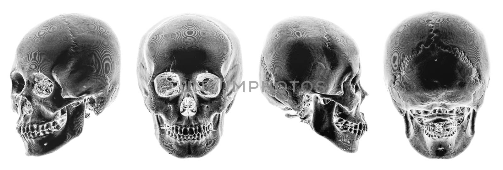 3D CT scan of human skull . Multiple view . Invert color style . by stockdevil
