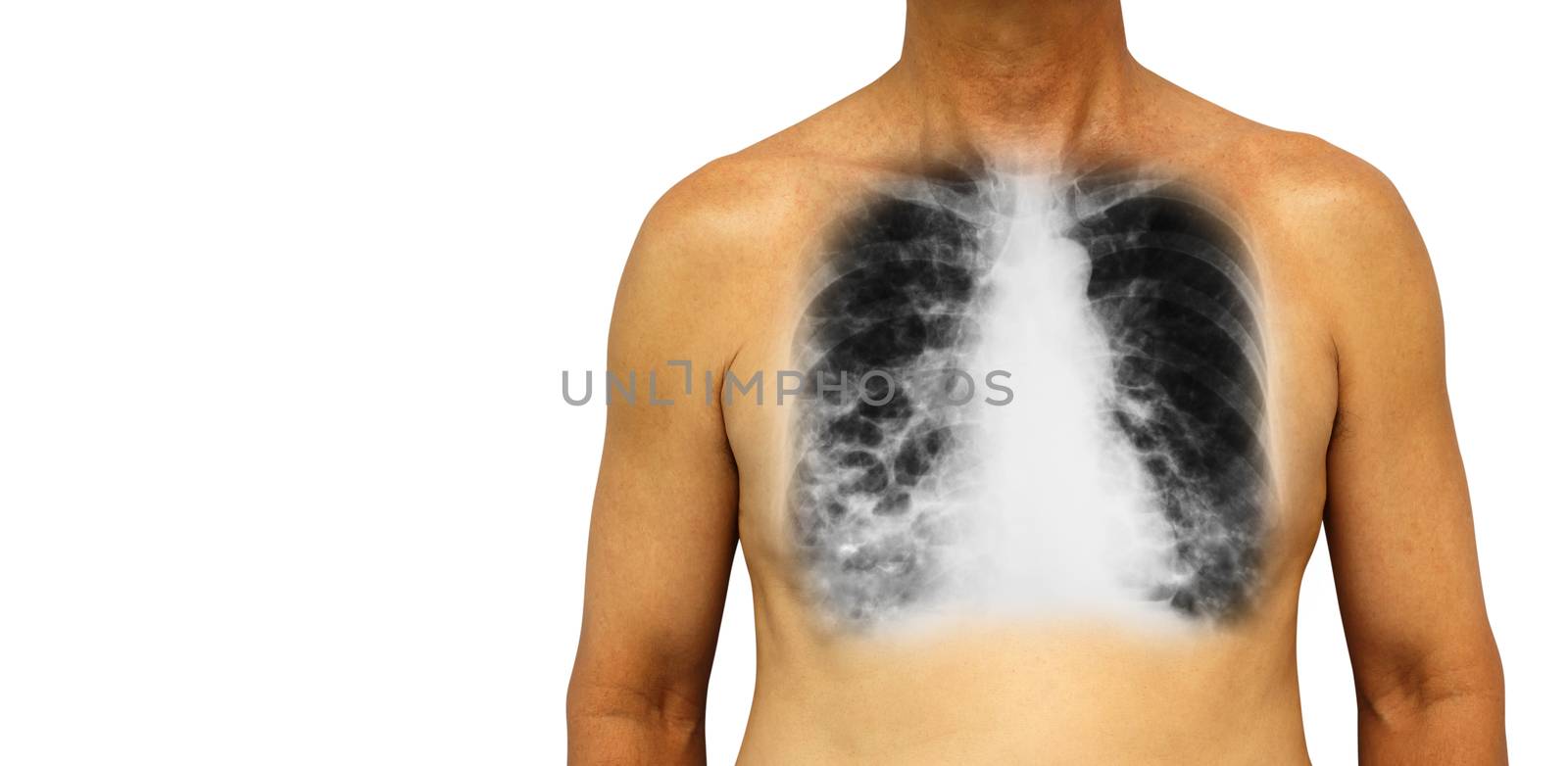 Bronchiectasis . Human chest with x-ray chest show multiple lung bleb and cyst due to chronic infection . Isolated background . Blank area at Left side .