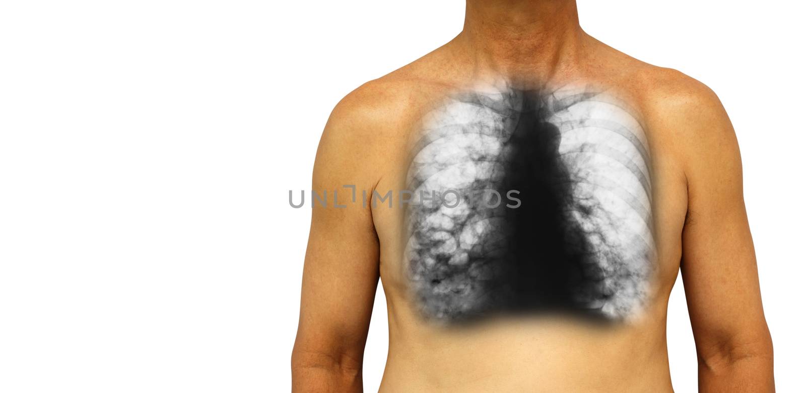 Bronchiectasis . Human chest with x-ray chest show multiple lung bleb and cyst due to chronic infection . Isolated background . Blank area at Left side by stockdevil