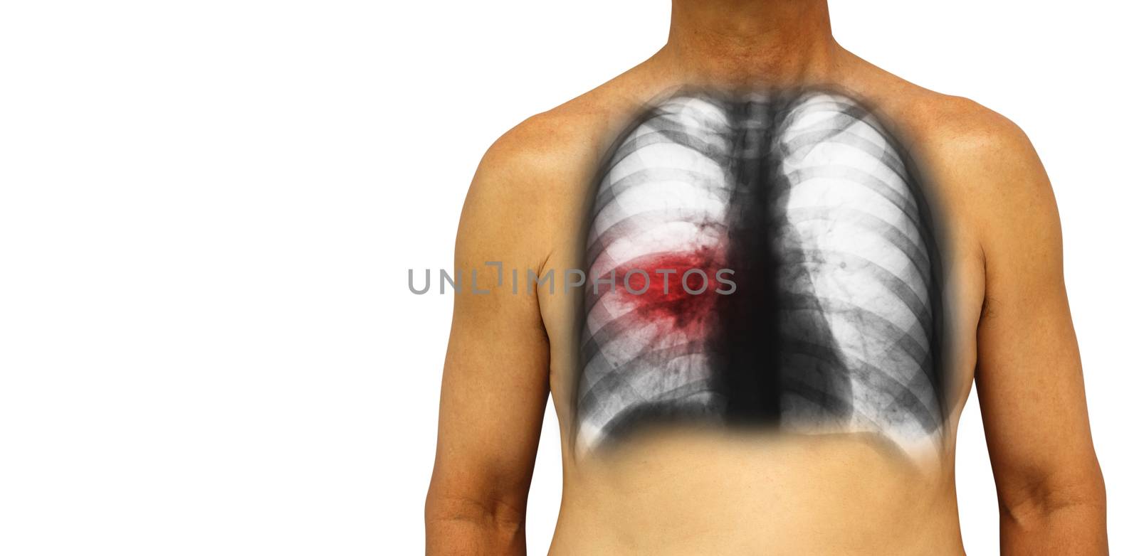 Pulmonary tuberculosis . Human chest with x-ray show patchy infiltrate at right lung due to infection . Isolated background . Blank area at Left side by stockdevil