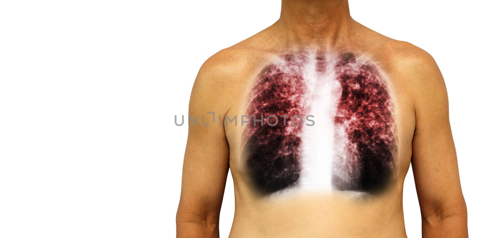 Pulmonary tuberculosis . Human chest with x-ray show interstitial infiltrate both lung due to infection . Isolated background . Blank area at Left side by stockdevil