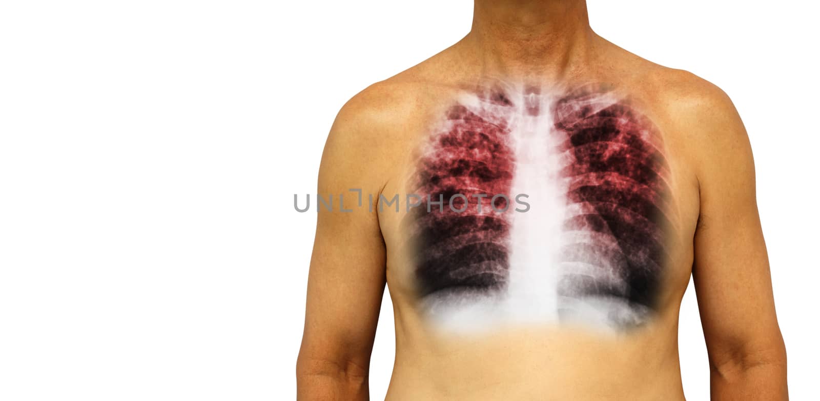 Pulmonary tuberculosis . Human chest with x-ray show interstitial infiltrate both lung due to infection . Isolated background . Blank area at Left side by stockdevil