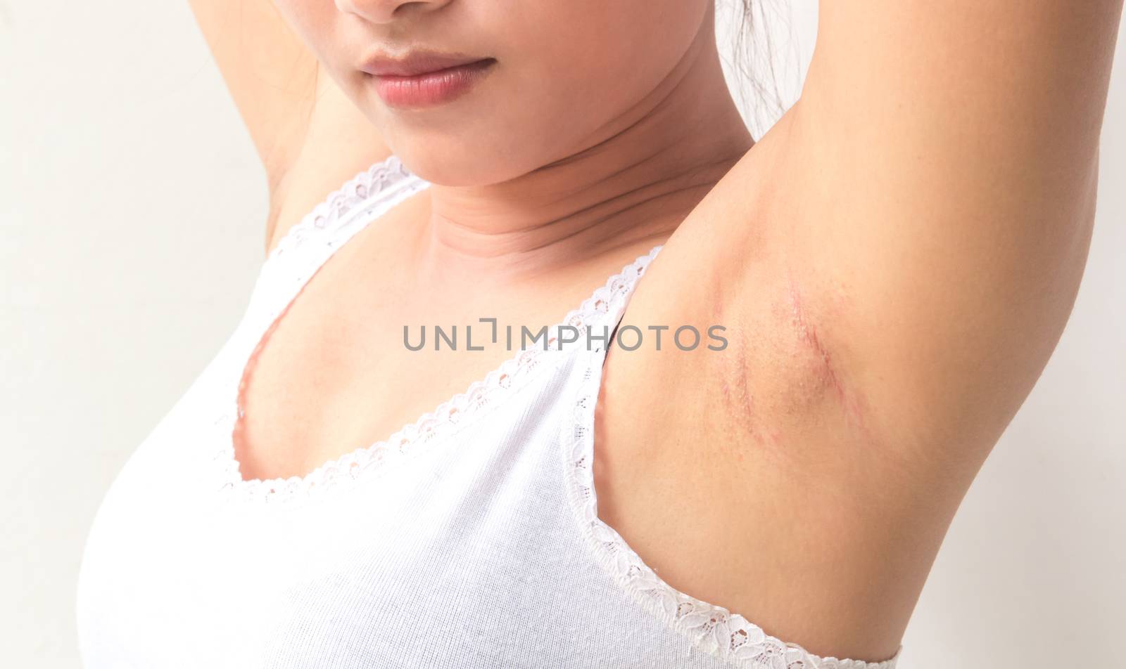 Women problem black armpit for skin care and beauty concept by pt.pongsak@gmail.com