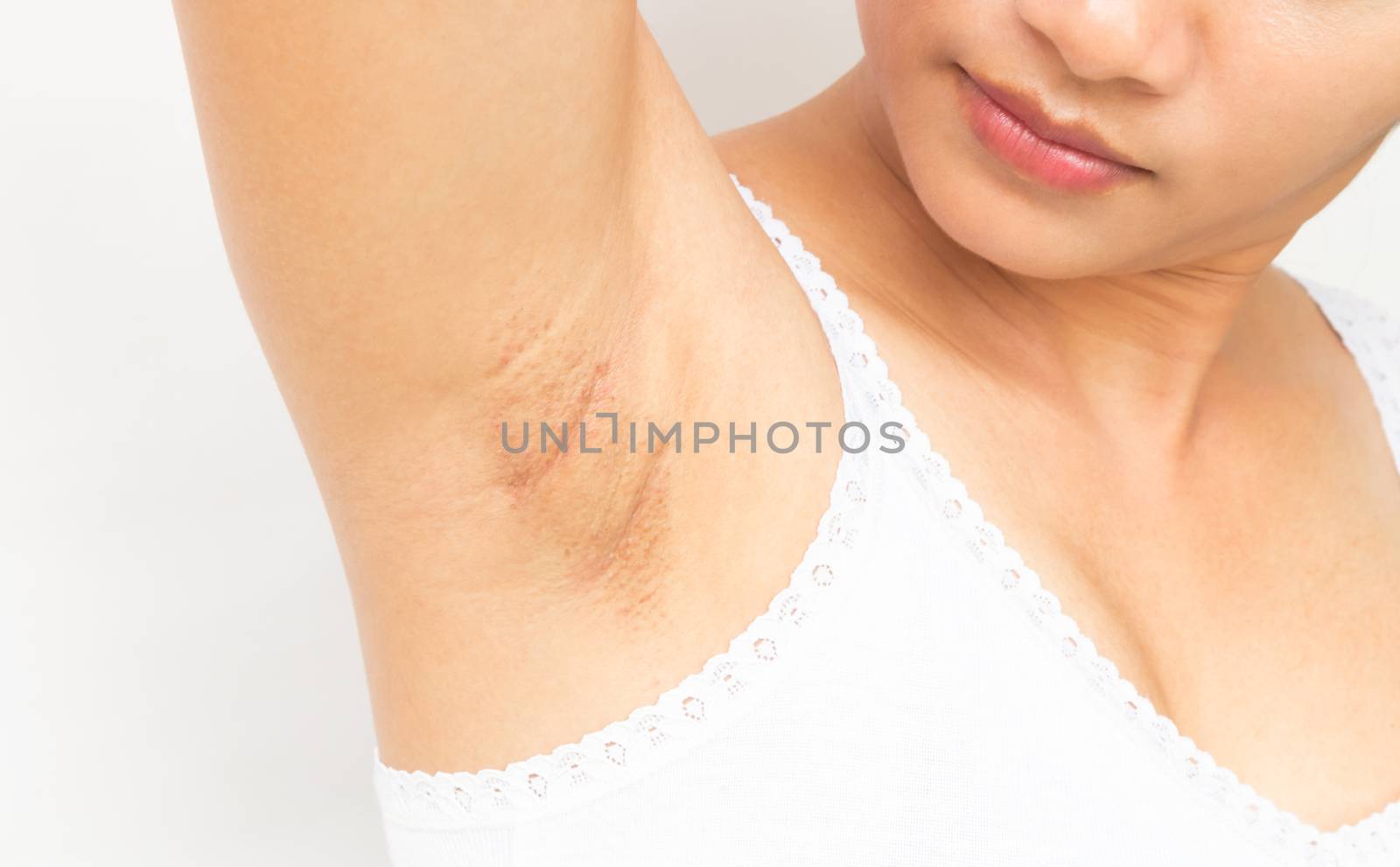 Women problem black armpit on white background for skin care and beauty concept