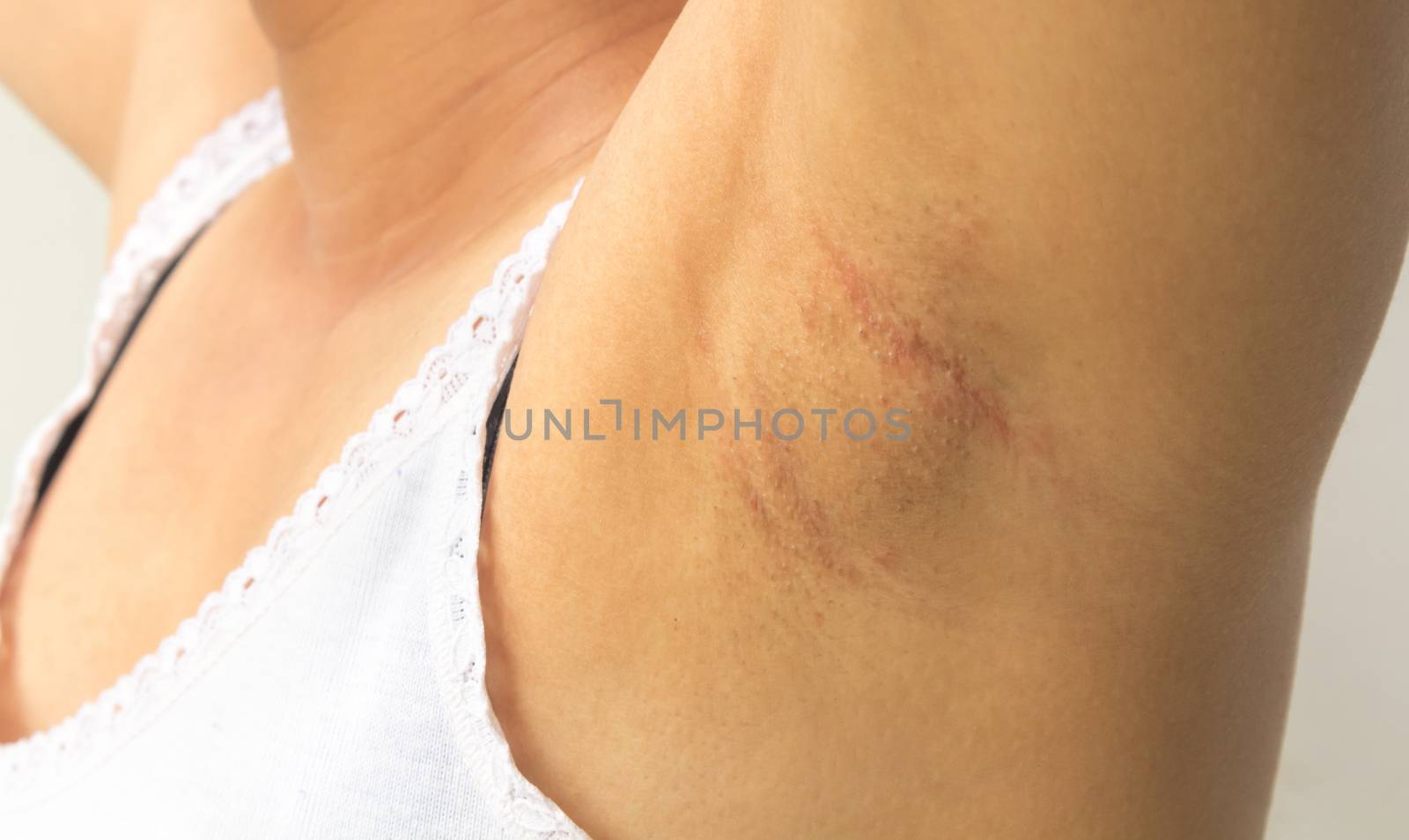 Women problem black armpit on white background for skin care and beauty concept