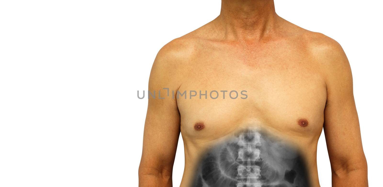 Colon cancer and Small intestine obstruction . Human abdomen with x-ray show small bowel dilated due to obstructed . Isolated background . Blank area at left side .