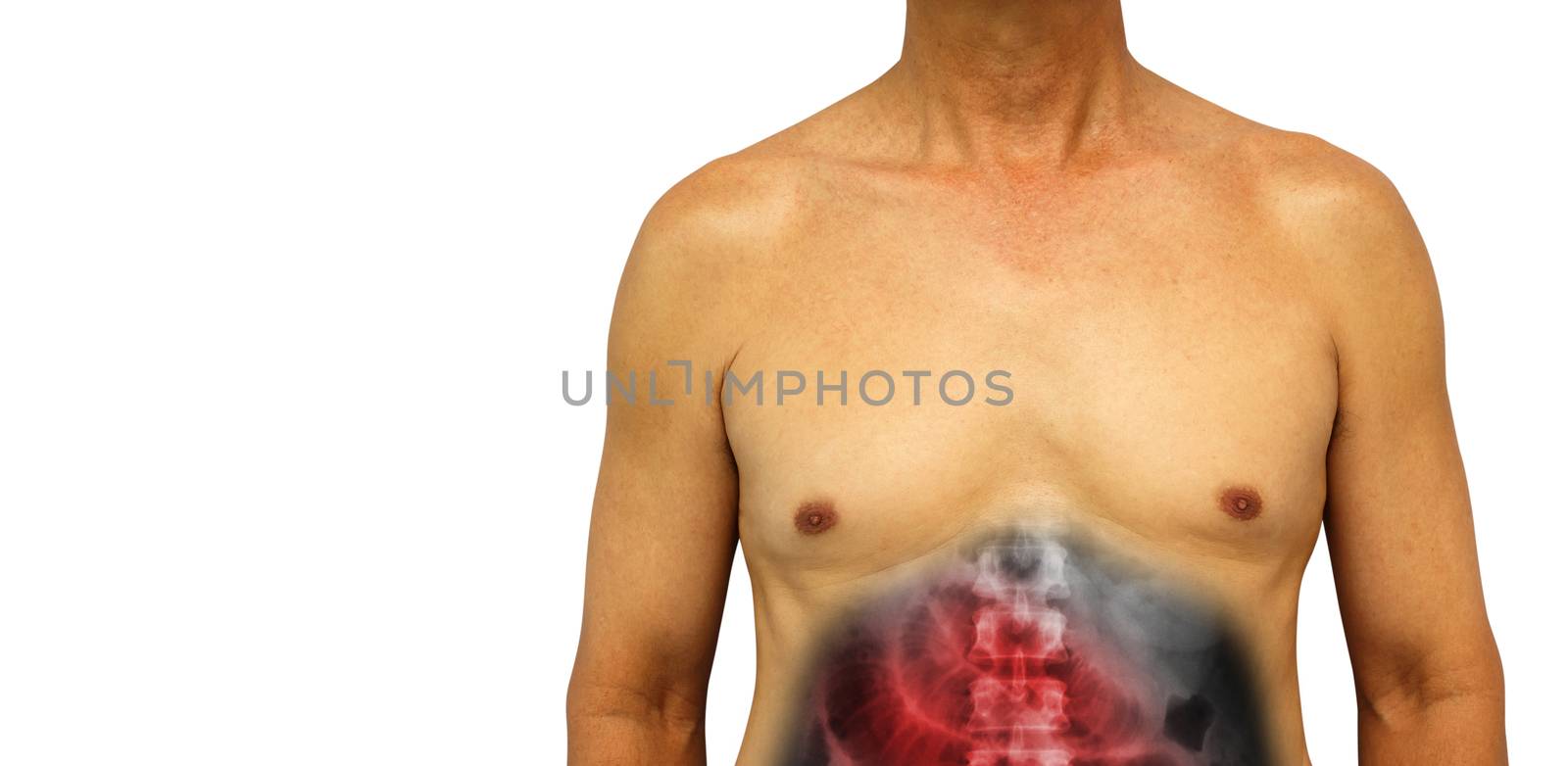 Colon cancer and Small intestine obstruction . Human abdomen with x-ray show small bowel dilated due to obstructed . Isolated background . Blank area at left side by stockdevil