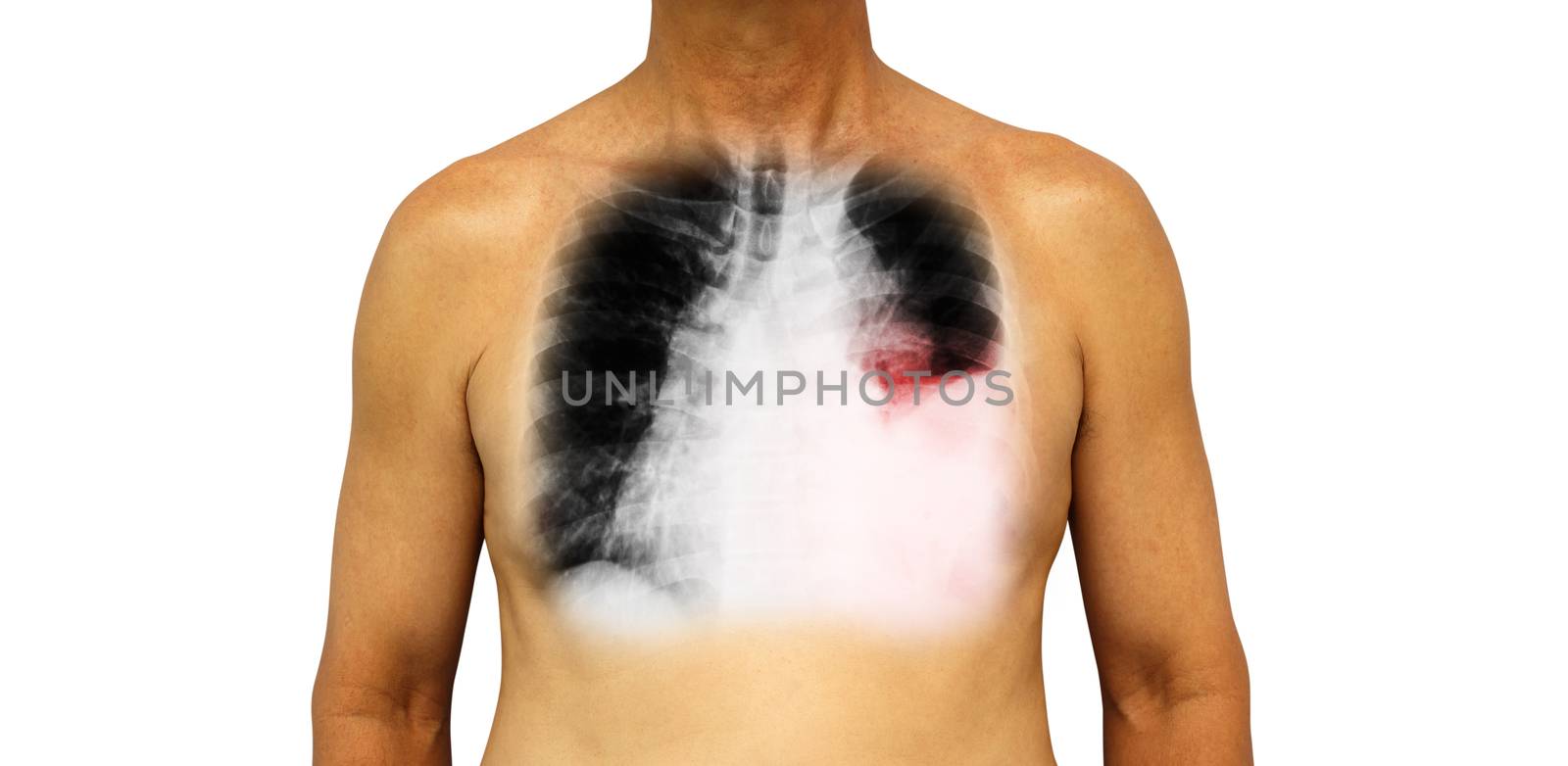 Lung cancer . Human chest and x-ray show pleural effusion left lung due to lung cancer by stockdevil
