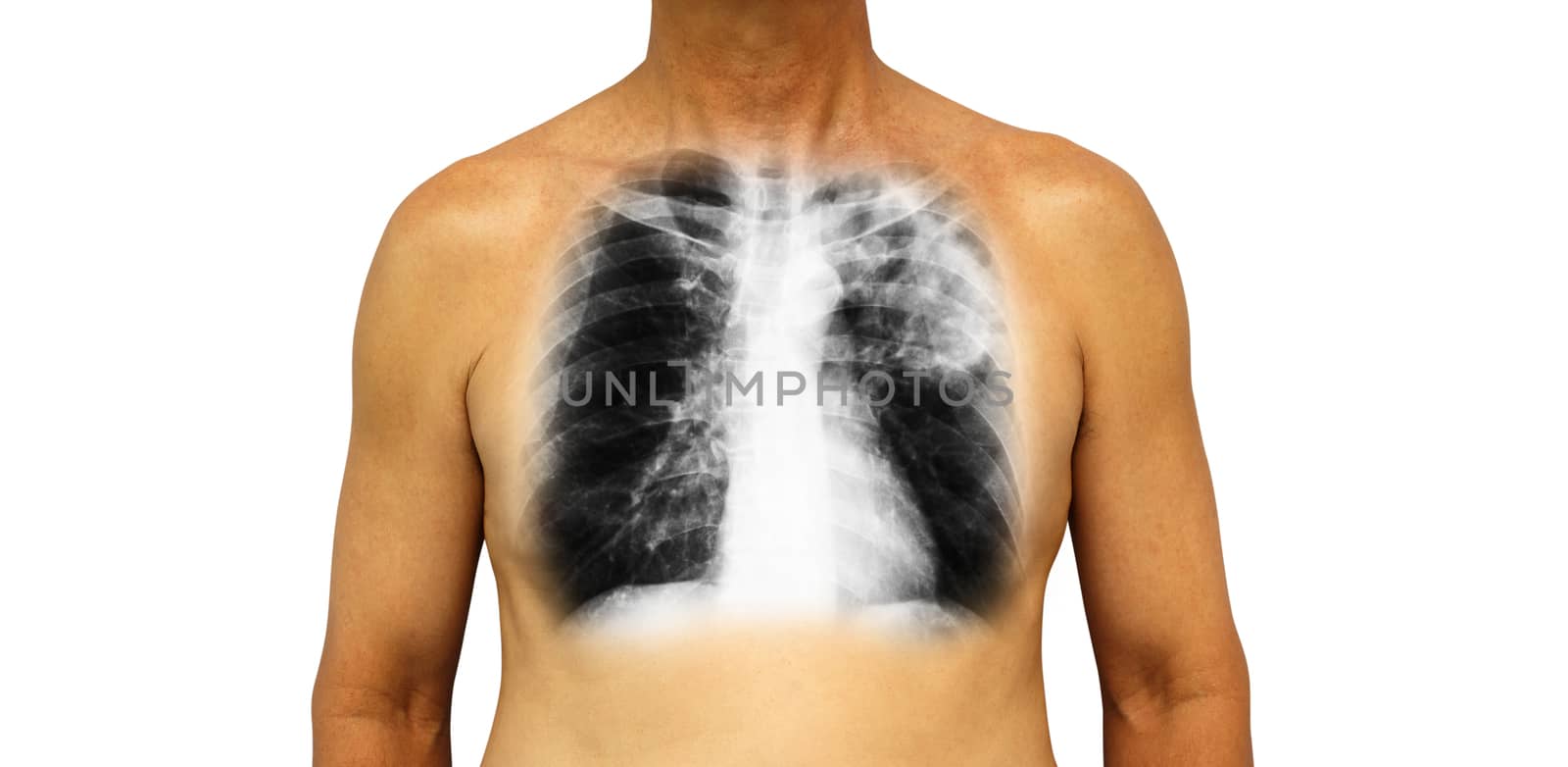 Pulmonary tuberculosis . Human chest with x-ray show patchy infiltrate left upper lung due to infection . Isolated background .