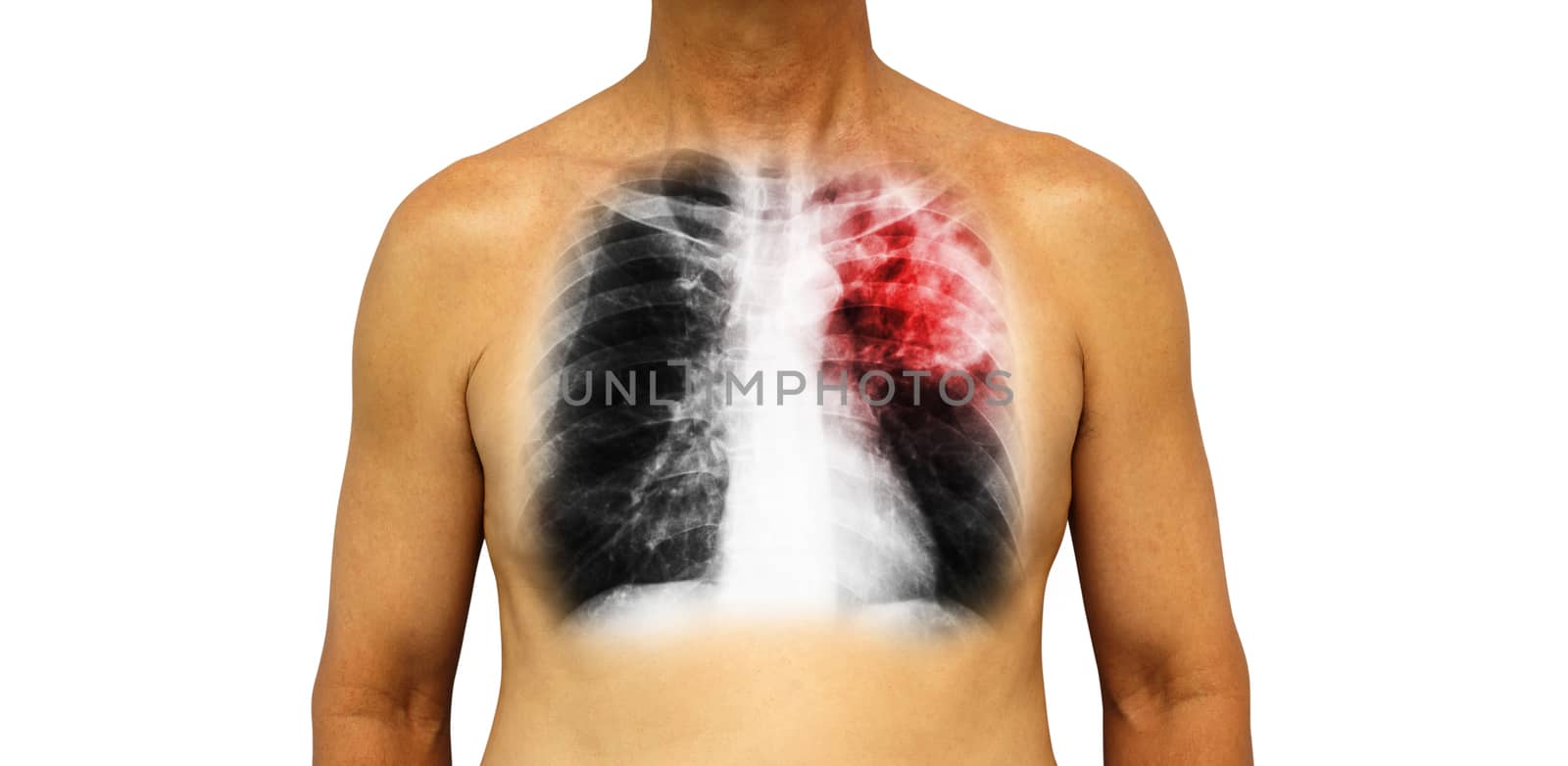 Pulmonary tuberculosis . Human chest with x-ray show patchy infiltrate left upper lung due to infection . Isolated background by stockdevil