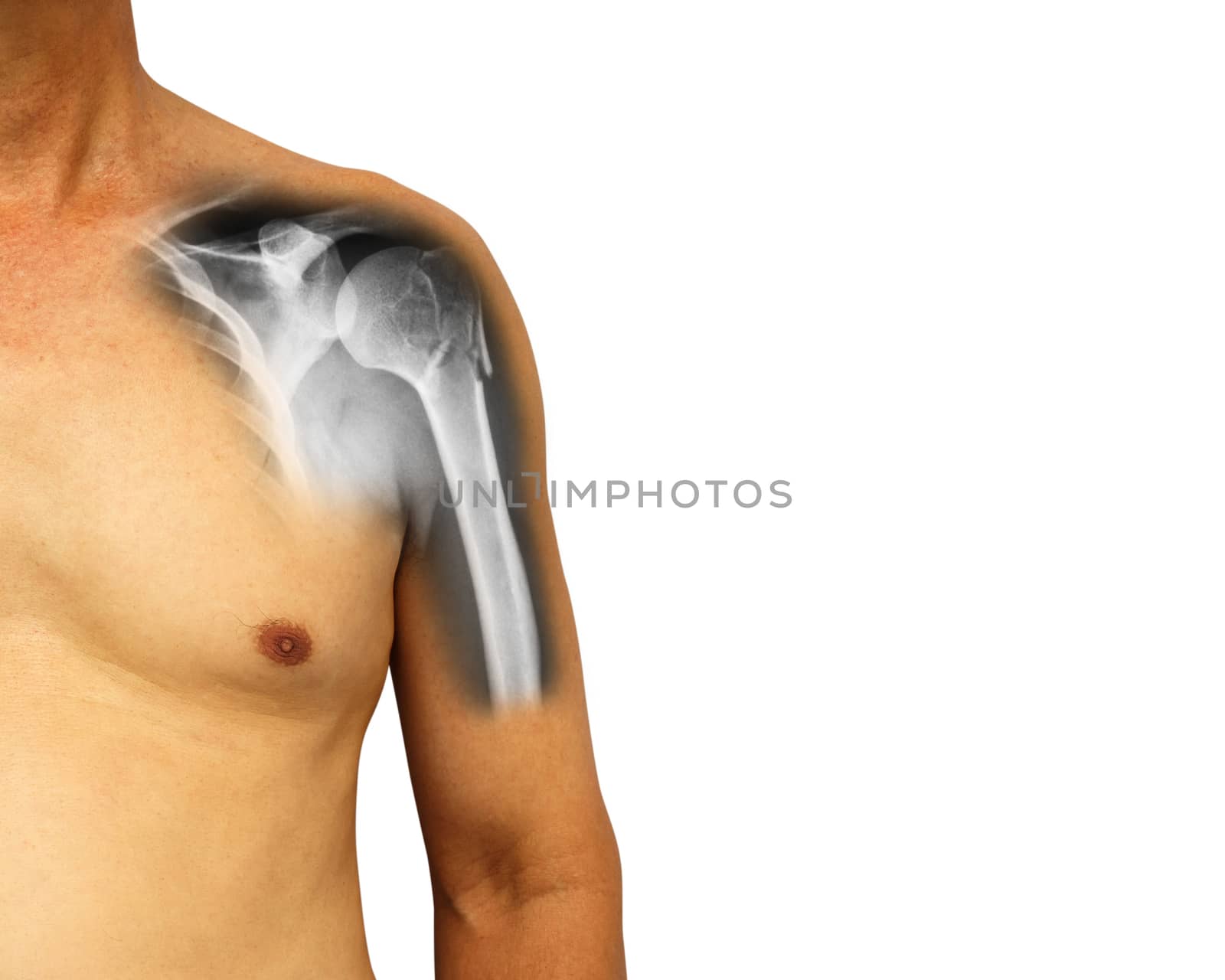 Human shoulder with x-ray show fracture at neck of humerus ( Arm bone ) . Isolated background . Blank area at right side by stockdevil