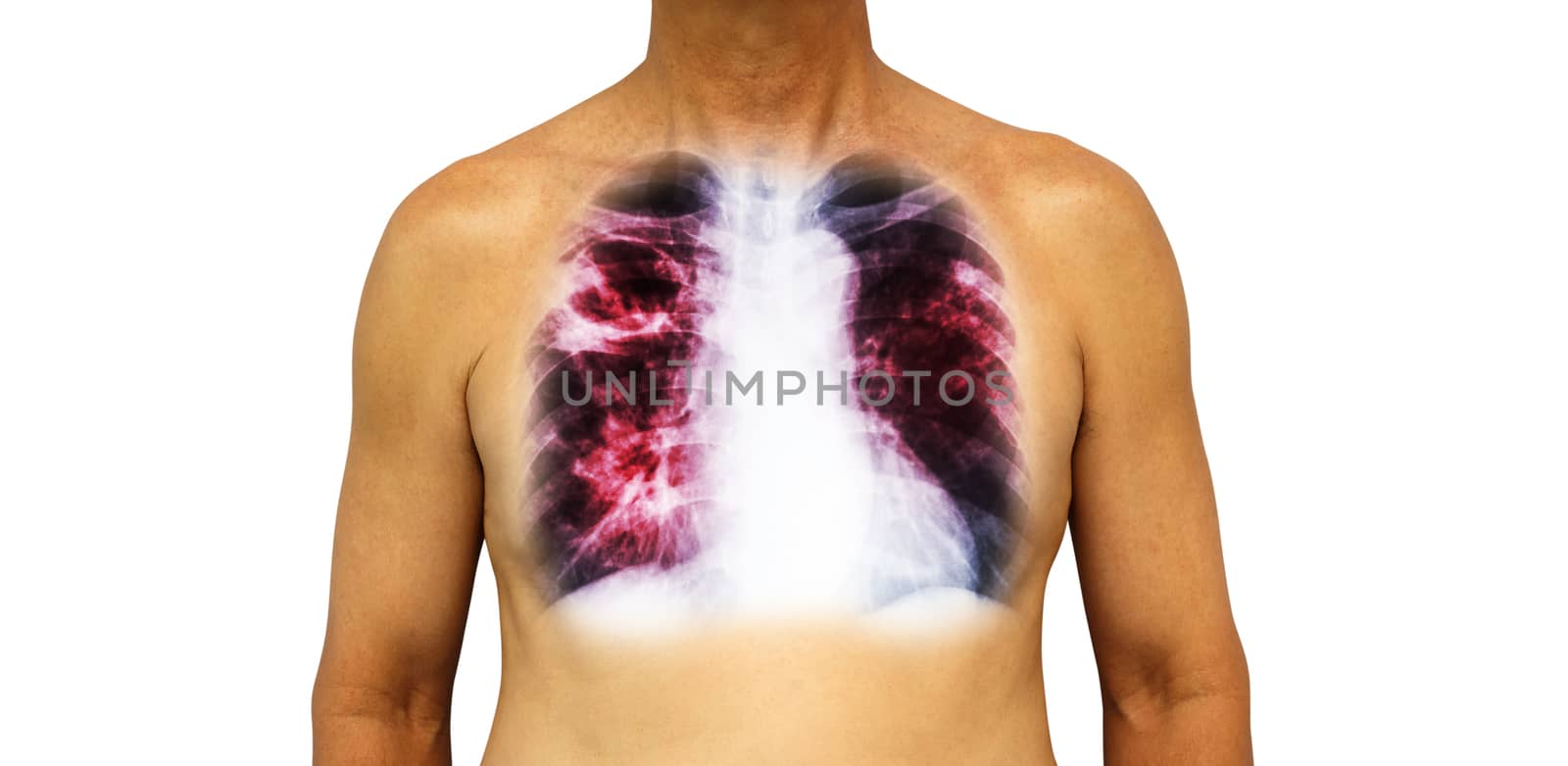 Pulmonary tuberculosis . Human chest with x-ray show cavity at right upper lung and interstitial infiltrate both lung due to infection . Isolated background by stockdevil